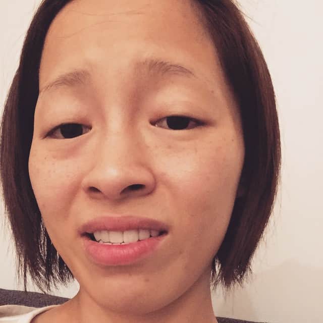 小森純さんのインスタグラム写真 小森純instagram 下の親知らず抜いた 麻酔切れると痛い ご飯たべれない 顔がボラみたい ムリ 抜いてよかったんだけど抜かなきゃよかった笑 このブスどうしよーーー W ブス イケてる 歯医者 親知らず カリスマモデル は