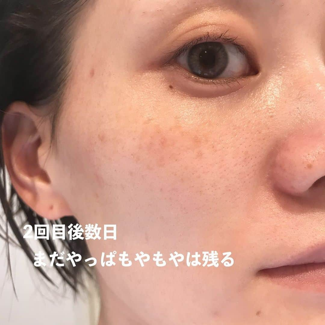 Arisaさんのインスタグラム写真 - (ArisaInstagram)「シミ治療してきてかれこれもう2年経つ。 たっかいデパコスの美白美容液とかクリームとかたくさん沢山使ってきたけど結局微々たる程度で、スキンケアにいくら投資したのかも分からない。 もうそれなら、美容皮膚科にお手伝いしてもらおうと思って通い出したのが幕張にある　@hadatoha 肌と歯のクリニック。 院長は余計なことは言わず、必要なものだけを勧め、必要なことしか言わない淡々とした院長wだけど、結果を見てもらえれば分かるはず。 腕がめちゃくちゃ良いんです。 千葉に住んでなくても遠方から来るお客様も多い。 正直ここまで綺麗にしてくれるとは考えてなかったし、莫大な金額がかかるとずっと思ってました。 （まぁ、それなりにかかってるけどスキンケア代金に比べたらね）  私は最初ライムライトコース（ピーリング→ライムライト→イオン導入　30,000円）をしばらくやっていて、6回目辺りからシミにはあまり反応しなくなってきたので、先生からこれ以上取りたいならレーザーだねと勧められましたが、金銭の関係で踏み込めず、2ヶ月に1回くらいライムライトコースを続けてました。  しかし、暫くしてどうせなら‼️ と思って【シミ半年治療プラン300,000円　モニター価格150,000円（顔出しだったかな？）】を契約しました。 （結果的に最初からこのコース組めばよかったと後悔、、、w）  このコースは半年間ライムライトコース6回分+シミ治療のレーザーは当て放題。なんてお得なんだ！と今は思えます。  ライムライトコースをしつつ、私は始めに【ピコレーザー（ピコスポットになるのかな？）】をやりました。 ライムライトでは反応しなかった薄いシミがめちゃくちゃ反応してくれて、これはYouTubeにも載せてます！ ※ただピコはダウンタイムが辛い！長い！ ピコはこの一度で、その後はダウンタイムがめちゃくちゃ少なく、より細かいシミに反応する【ルビーフラクショナル】を3度あてました！ これもYouTube載せてます！ これは史上最強に激痛なのですが、まあダウンタイムが少ないのなんの。 そして深いシミが取れる。 赤みとかにもとても効いてる気がする🤔  そしてやはりシミを取ると気になるのがホクロ。 どうせならと、炭酸ガスレーザーやQスイッチルビーレーザーなどで取りました！ 炭酸ガスだとしっかり取れるけど、赤みが引くまで半年程かかったなぁ。 この間はQスイッチルビーレーザーで取ったけど、赤みが少しあるくらいで炭酸ガスほどのダウンタイムはない！ ※Qスイッチだと2、3度やらないと完全には消えないです。 そんなこんなで久しぶりに美容皮膚科のレポートをしてみました！  スキンケアは変えずにトゥルーストナーとトゥルースドロップ、NANOAのクリーム使ってます☺️ ※ゼオスキンやエンビロンなどは一切使ってません。  質問コーナーとかでもお伝えしてますが、やはり化粧品でシミを取るのはコストがかかるし、100%取れるものではありません。 長い目を見て、シミと縁を切るのであれば是非私はレーザーに頼ることを勧めます。  私は、レーザーでシミ治療してスキンケアはシンプル‼️が一番好きです。  ここのクリニックにお願いして本当によかったと思えました。  ・ ・ #美容皮膚科#皮膚治療#シミ治療#ピコレーザー#ルビーレーザー#ピコフラクショナル#ルビーフラクショナル#肌と歯のクリニック#千葉美容皮膚科#ホクロ除去#ダウンタイム#ダウンタイム中#ダウンタイム記録#ダウンタイム経過#皮膚科通い」12月22日 19時05分 - saarariii