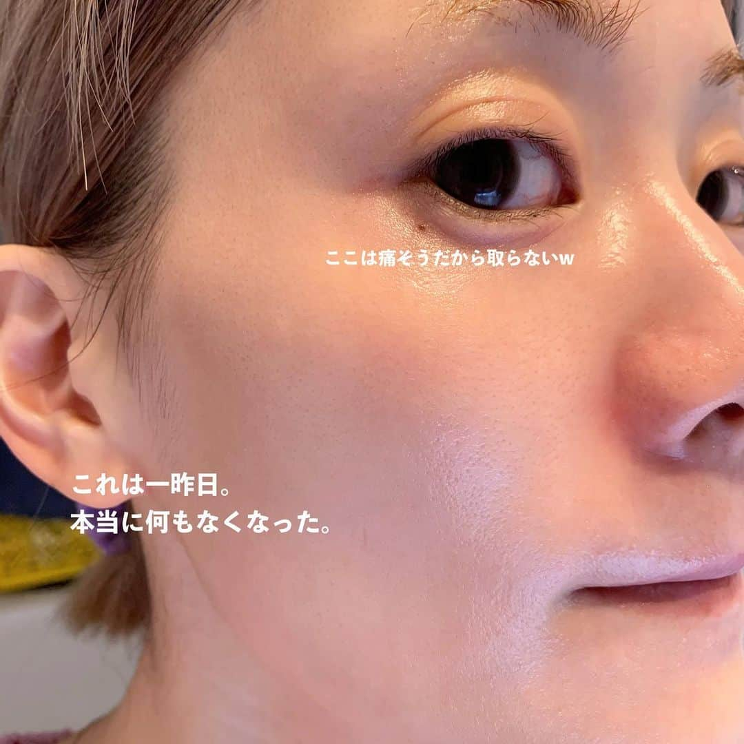 Arisaさんのインスタグラム写真 - (ArisaInstagram)「シミ治療してきてかれこれもう2年経つ。 たっかいデパコスの美白美容液とかクリームとかたくさん沢山使ってきたけど結局微々たる程度で、スキンケアにいくら投資したのかも分からない。 もうそれなら、美容皮膚科にお手伝いしてもらおうと思って通い出したのが幕張にある　@hadatoha 肌と歯のクリニック。 院長は余計なことは言わず、必要なものだけを勧め、必要なことしか言わない淡々とした院長wだけど、結果を見てもらえれば分かるはず。 腕がめちゃくちゃ良いんです。 千葉に住んでなくても遠方から来るお客様も多い。 正直ここまで綺麗にしてくれるとは考えてなかったし、莫大な金額がかかるとずっと思ってました。 （まぁ、それなりにかかってるけどスキンケア代金に比べたらね）  私は最初ライムライトコース（ピーリング→ライムライト→イオン導入　30,000円）をしばらくやっていて、6回目辺りからシミにはあまり反応しなくなってきたので、先生からこれ以上取りたいならレーザーだねと勧められましたが、金銭の関係で踏み込めず、2ヶ月に1回くらいライムライトコースを続けてました。  しかし、暫くしてどうせなら‼️ と思って【シミ半年治療プラン300,000円　モニター価格150,000円（顔出しだったかな？）】を契約しました。 （結果的に最初からこのコース組めばよかったと後悔、、、w）  このコースは半年間ライムライトコース6回分+シミ治療のレーザーは当て放題。なんてお得なんだ！と今は思えます。  ライムライトコースをしつつ、私は始めに【ピコレーザー（ピコスポットになるのかな？）】をやりました。 ライムライトでは反応しなかった薄いシミがめちゃくちゃ反応してくれて、これはYouTubeにも載せてます！ ※ただピコはダウンタイムが辛い！長い！ ピコはこの一度で、その後はダウンタイムがめちゃくちゃ少なく、より細かいシミに反応する【ルビーフラクショナル】を3度あてました！ これもYouTube載せてます！ これは史上最強に激痛なのですが、まあダウンタイムが少ないのなんの。 そして深いシミが取れる。 赤みとかにもとても効いてる気がする🤔  そしてやはりシミを取ると気になるのがホクロ。 どうせならと、炭酸ガスレーザーやQスイッチルビーレーザーなどで取りました！ 炭酸ガスだとしっかり取れるけど、赤みが引くまで半年程かかったなぁ。 この間はQスイッチルビーレーザーで取ったけど、赤みが少しあるくらいで炭酸ガスほどのダウンタイムはない！ ※Qスイッチだと2、3度やらないと完全には消えないです。 そんなこんなで久しぶりに美容皮膚科のレポートをしてみました！  スキンケアは変えずにトゥルーストナーとトゥルースドロップ、NANOAのクリーム使ってます☺️ ※ゼオスキンやエンビロンなどは一切使ってません。  質問コーナーとかでもお伝えしてますが、やはり化粧品でシミを取るのはコストがかかるし、100%取れるものではありません。 長い目を見て、シミと縁を切るのであれば是非私はレーザーに頼ることを勧めます。  私は、レーザーでシミ治療してスキンケアはシンプル‼️が一番好きです。  ここのクリニックにお願いして本当によかったと思えました。  ・ ・ #美容皮膚科#皮膚治療#シミ治療#ピコレーザー#ルビーレーザー#ピコフラクショナル#ルビーフラクショナル#肌と歯のクリニック#千葉美容皮膚科#ホクロ除去#ダウンタイム#ダウンタイム中#ダウンタイム記録#ダウンタイム経過#皮膚科通い」12月22日 19時05分 - saarariii