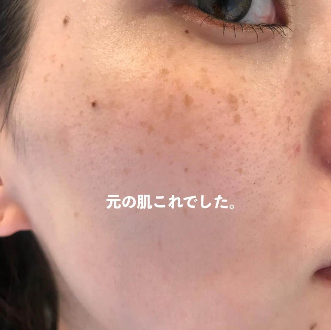 Arisaさんのインスタグラム写真 - (ArisaInstagram)「シミ治療してきてかれこれもう2年経つ。 たっかいデパコスの美白美容液とかクリームとかたくさん沢山使ってきたけど結局微々たる程度で、スキンケアにいくら投資したのかも分からない。 もうそれなら、美容皮膚科にお手伝いしてもらおうと思って通い出したのが幕張にある　@hadatoha 肌と歯のクリニック。 院長は余計なことは言わず、必要なものだけを勧め、必要なことしか言わない淡々とした院長wだけど、結果を見てもらえれば分かるはず。 腕がめちゃくちゃ良いんです。 千葉に住んでなくても遠方から来るお客様も多い。 正直ここまで綺麗にしてくれるとは考えてなかったし、莫大な金額がかかるとずっと思ってました。 （まぁ、それなりにかかってるけどスキンケア代金に比べたらね）  私は最初ライムライトコース（ピーリング→ライムライト→イオン導入　30,000円）をしばらくやっていて、6回目辺りからシミにはあまり反応しなくなってきたので、先生からこれ以上取りたいならレーザーだねと勧められましたが、金銭の関係で踏み込めず、2ヶ月に1回くらいライムライトコースを続けてました。  しかし、暫くしてどうせなら‼️ と思って【シミ半年治療プラン300,000円　モニター価格150,000円（顔出しだったかな？）】を契約しました。 （結果的に最初からこのコース組めばよかったと後悔、、、w）  このコースは半年間ライムライトコース6回分+シミ治療のレーザーは当て放題。なんてお得なんだ！と今は思えます。  ライムライトコースをしつつ、私は始めに【ピコレーザー（ピコスポットになるのかな？）】をやりました。 ライムライトでは反応しなかった薄いシミがめちゃくちゃ反応してくれて、これはYouTubeにも載せてます！ ※ただピコはダウンタイムが辛い！長い！ ピコはこの一度で、その後はダウンタイムがめちゃくちゃ少なく、より細かいシミに反応する【ルビーフラクショナル】を3度あてました！ これもYouTube載せてます！ これは史上最強に激痛なのですが、まあダウンタイムが少ないのなんの。 そして深いシミが取れる。 赤みとかにもとても効いてる気がする🤔  そしてやはりシミを取ると気になるのがホクロ。 どうせならと、炭酸ガスレーザーやQスイッチルビーレーザーなどで取りました！ 炭酸ガスだとしっかり取れるけど、赤みが引くまで半年程かかったなぁ。 この間はQスイッチルビーレーザーで取ったけど、赤みが少しあるくらいで炭酸ガスほどのダウンタイムはない！ ※Qスイッチだと2、3度やらないと完全には消えないです。 そんなこんなで久しぶりに美容皮膚科のレポートをしてみました！  スキンケアは変えずにトゥルーストナーとトゥルースドロップ、NANOAのクリーム使ってます☺️ ※ゼオスキンやエンビロンなどは一切使ってません。  質問コーナーとかでもお伝えしてますが、やはり化粧品でシミを取るのはコストがかかるし、100%取れるものではありません。 長い目を見て、シミと縁を切るのであれば是非私はレーザーに頼ることを勧めます。  私は、レーザーでシミ治療してスキンケアはシンプル‼️が一番好きです。  ここのクリニックにお願いして本当によかったと思えました。  ・ ・ #美容皮膚科#皮膚治療#シミ治療#ピコレーザー#ルビーレーザー#ピコフラクショナル#ルビーフラクショナル#肌と歯のクリニック#千葉美容皮膚科#ホクロ除去#ダウンタイム#ダウンタイム中#ダウンタイム記録#ダウンタイム経過#皮膚科通い」12月22日 19時05分 - saarariii