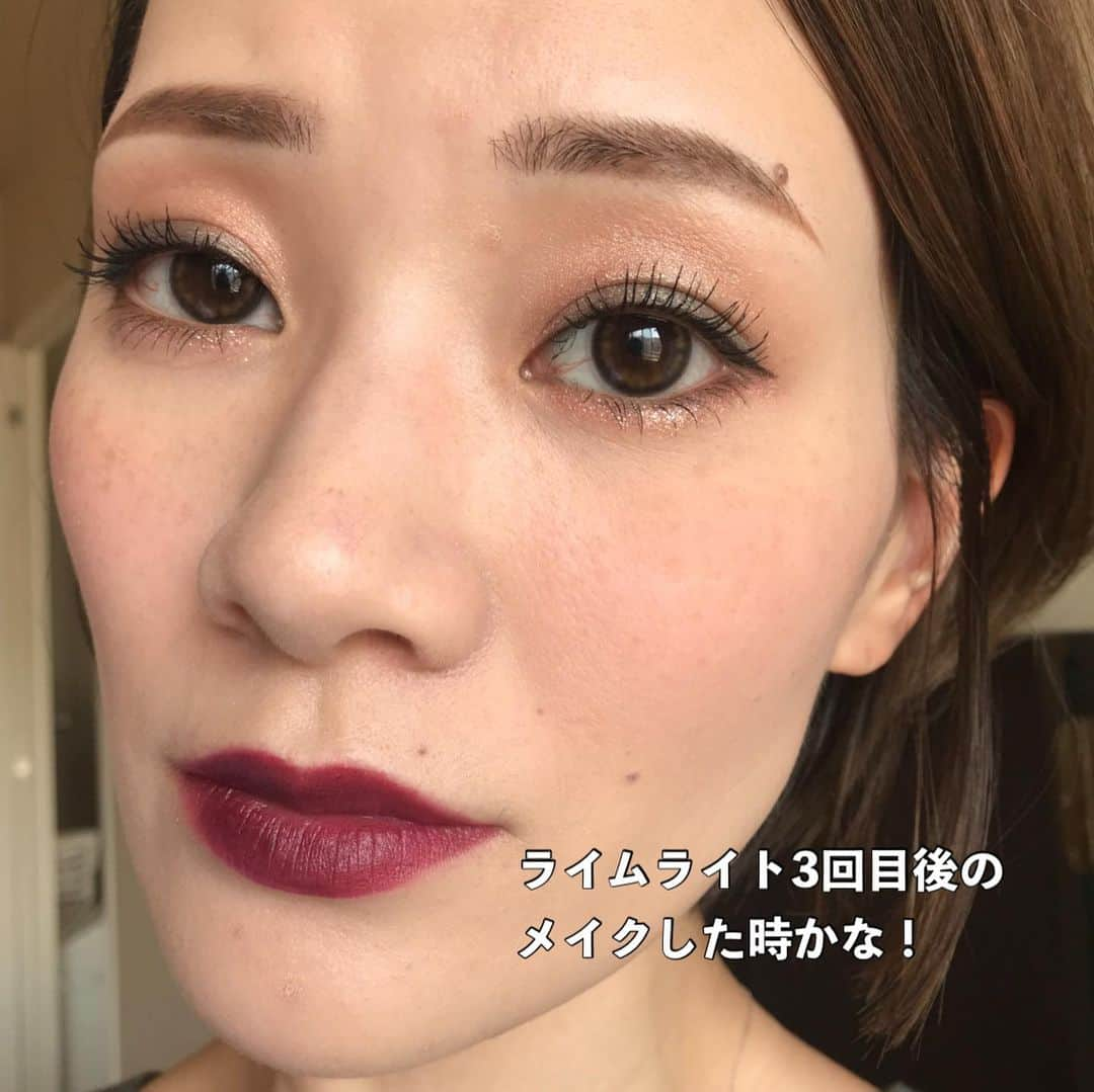 Arisaさんのインスタグラム写真 - (ArisaInstagram)「シミ治療してきてかれこれもう2年経つ。 たっかいデパコスの美白美容液とかクリームとかたくさん沢山使ってきたけど結局微々たる程度で、スキンケアにいくら投資したのかも分からない。 もうそれなら、美容皮膚科にお手伝いしてもらおうと思って通い出したのが幕張にある　@hadatoha 肌と歯のクリニック。 院長は余計なことは言わず、必要なものだけを勧め、必要なことしか言わない淡々とした院長wだけど、結果を見てもらえれば分かるはず。 腕がめちゃくちゃ良いんです。 千葉に住んでなくても遠方から来るお客様も多い。 正直ここまで綺麗にしてくれるとは考えてなかったし、莫大な金額がかかるとずっと思ってました。 （まぁ、それなりにかかってるけどスキンケア代金に比べたらね）  私は最初ライムライトコース（ピーリング→ライムライト→イオン導入　30,000円）をしばらくやっていて、6回目辺りからシミにはあまり反応しなくなってきたので、先生からこれ以上取りたいならレーザーだねと勧められましたが、金銭の関係で踏み込めず、2ヶ月に1回くらいライムライトコースを続けてました。  しかし、暫くしてどうせなら‼️ と思って【シミ半年治療プラン300,000円　モニター価格150,000円（顔出しだったかな？）】を契約しました。 （結果的に最初からこのコース組めばよかったと後悔、、、w）  このコースは半年間ライムライトコース6回分+シミ治療のレーザーは当て放題。なんてお得なんだ！と今は思えます。  ライムライトコースをしつつ、私は始めに【ピコレーザー（ピコスポットになるのかな？）】をやりました。 ライムライトでは反応しなかった薄いシミがめちゃくちゃ反応してくれて、これはYouTubeにも載せてます！ ※ただピコはダウンタイムが辛い！長い！ ピコはこの一度で、その後はダウンタイムがめちゃくちゃ少なく、より細かいシミに反応する【ルビーフラクショナル】を3度あてました！ これもYouTube載せてます！ これは史上最強に激痛なのですが、まあダウンタイムが少ないのなんの。 そして深いシミが取れる。 赤みとかにもとても効いてる気がする🤔  そしてやはりシミを取ると気になるのがホクロ。 どうせならと、炭酸ガスレーザーやQスイッチルビーレーザーなどで取りました！ 炭酸ガスだとしっかり取れるけど、赤みが引くまで半年程かかったなぁ。 この間はQスイッチルビーレーザーで取ったけど、赤みが少しあるくらいで炭酸ガスほどのダウンタイムはない！ ※Qスイッチだと2、3度やらないと完全には消えないです。 そんなこんなで久しぶりに美容皮膚科のレポートをしてみました！  スキンケアは変えずにトゥルーストナーとトゥルースドロップ、NANOAのクリーム使ってます☺️ ※ゼオスキンやエンビロンなどは一切使ってません。  質問コーナーとかでもお伝えしてますが、やはり化粧品でシミを取るのはコストがかかるし、100%取れるものではありません。 長い目を見て、シミと縁を切るのであれば是非私はレーザーに頼ることを勧めます。  私は、レーザーでシミ治療してスキンケアはシンプル‼️が一番好きです。  ここのクリニックにお願いして本当によかったと思えました。  ・ ・ #美容皮膚科#皮膚治療#シミ治療#ピコレーザー#ルビーレーザー#ピコフラクショナル#ルビーフラクショナル#肌と歯のクリニック#千葉美容皮膚科#ホクロ除去#ダウンタイム#ダウンタイム中#ダウンタイム記録#ダウンタイム経過#皮膚科通い」12月22日 19時05分 - saarariii