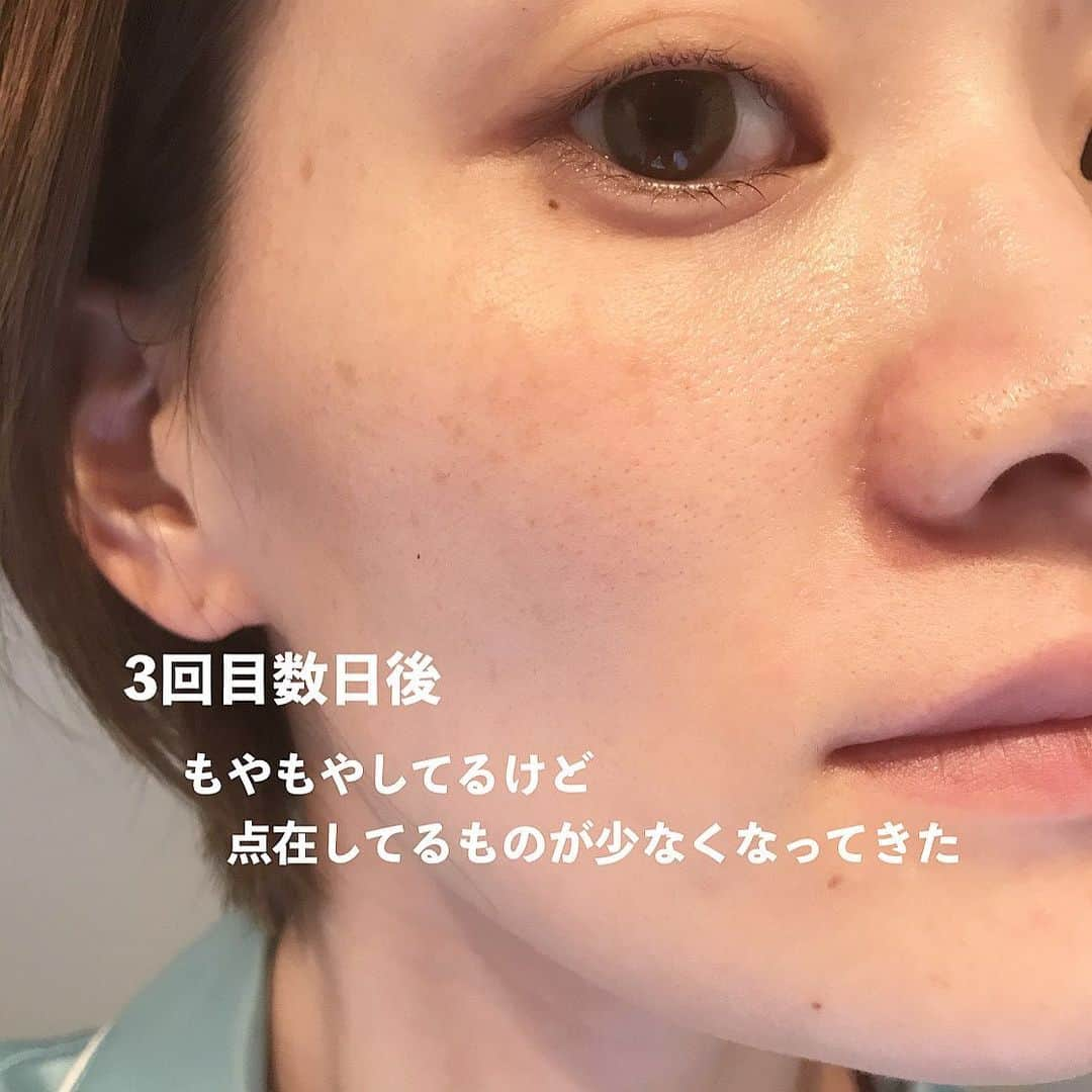 Arisaさんのインスタグラム写真 - (ArisaInstagram)「シミ治療してきてかれこれもう2年経つ。 たっかいデパコスの美白美容液とかクリームとかたくさん沢山使ってきたけど結局微々たる程度で、スキンケアにいくら投資したのかも分からない。 もうそれなら、美容皮膚科にお手伝いしてもらおうと思って通い出したのが幕張にある　@hadatoha 肌と歯のクリニック。 院長は余計なことは言わず、必要なものだけを勧め、必要なことしか言わない淡々とした院長wだけど、結果を見てもらえれば分かるはず。 腕がめちゃくちゃ良いんです。 千葉に住んでなくても遠方から来るお客様も多い。 正直ここまで綺麗にしてくれるとは考えてなかったし、莫大な金額がかかるとずっと思ってました。 （まぁ、それなりにかかってるけどスキンケア代金に比べたらね）  私は最初ライムライトコース（ピーリング→ライムライト→イオン導入　30,000円）をしばらくやっていて、6回目辺りからシミにはあまり反応しなくなってきたので、先生からこれ以上取りたいならレーザーだねと勧められましたが、金銭の関係で踏み込めず、2ヶ月に1回くらいライムライトコースを続けてました。  しかし、暫くしてどうせなら‼️ と思って【シミ半年治療プラン300,000円　モニター価格150,000円（顔出しだったかな？）】を契約しました。 （結果的に最初からこのコース組めばよかったと後悔、、、w）  このコースは半年間ライムライトコース6回分+シミ治療のレーザーは当て放題。なんてお得なんだ！と今は思えます。  ライムライトコースをしつつ、私は始めに【ピコレーザー（ピコスポットになるのかな？）】をやりました。 ライムライトでは反応しなかった薄いシミがめちゃくちゃ反応してくれて、これはYouTubeにも載せてます！ ※ただピコはダウンタイムが辛い！長い！ ピコはこの一度で、その後はダウンタイムがめちゃくちゃ少なく、より細かいシミに反応する【ルビーフラクショナル】を3度あてました！ これもYouTube載せてます！ これは史上最強に激痛なのですが、まあダウンタイムが少ないのなんの。 そして深いシミが取れる。 赤みとかにもとても効いてる気がする🤔  そしてやはりシミを取ると気になるのがホクロ。 どうせならと、炭酸ガスレーザーやQスイッチルビーレーザーなどで取りました！ 炭酸ガスだとしっかり取れるけど、赤みが引くまで半年程かかったなぁ。 この間はQスイッチルビーレーザーで取ったけど、赤みが少しあるくらいで炭酸ガスほどのダウンタイムはない！ ※Qスイッチだと2、3度やらないと完全には消えないです。 そんなこんなで久しぶりに美容皮膚科のレポートをしてみました！  スキンケアは変えずにトゥルーストナーとトゥルースドロップ、NANOAのクリーム使ってます☺️ ※ゼオスキンやエンビロンなどは一切使ってません。  質問コーナーとかでもお伝えしてますが、やはり化粧品でシミを取るのはコストがかかるし、100%取れるものではありません。 長い目を見て、シミと縁を切るのであれば是非私はレーザーに頼ることを勧めます。  私は、レーザーでシミ治療してスキンケアはシンプル‼️が一番好きです。  ここのクリニックにお願いして本当によかったと思えました。  ・ ・ #美容皮膚科#皮膚治療#シミ治療#ピコレーザー#ルビーレーザー#ピコフラクショナル#ルビーフラクショナル#肌と歯のクリニック#千葉美容皮膚科#ホクロ除去#ダウンタイム#ダウンタイム中#ダウンタイム記録#ダウンタイム経過#皮膚科通い」12月22日 19時05分 - saarariii