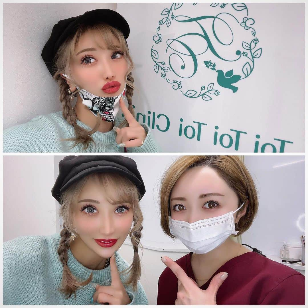 AIKAさんのインスタグラム写真 - (AIKAInstagram)「. 💋ずっとやりたかった唇アートメイク💋 . やってもらったのは トイトイトイクリニック池袋院 ( @toi_.art )の 黒田さん♥️( @toi_kuroda ) . やった初日だけ真っ赤だけど 2、3日経って皮が剥けてくると 色も落ち着いて最初決めた色になる✨ すっぴんでもメイクしてるみたいで めちゃくちゃ綺麗だしほんと楽だし メイクしてもグロス塗って終了🤩 . ストーリーに経過載っけてたから 見てた人はわかると思うけど 落ち着いてきて良いでしょ🙌🏼😍 友達からもめちゃ褒められるし聞かれる！ . 縁取りもするから縁がボケボケ してる人なんかにもオススメ(自分がそうだった) . やりたい人は連絡する時 「AIKAのインスタを見た！」で コース契約の場合に限りだけど 15%オフにしてくれるらひーよ😳👏🏽 . 【注意事項】 ※15%オフは院内の他のキャンペーンと併用不可。 ※15%オフの適応はコース契約に限ります。 ※アートメイクは2回コースのみ対象です。 . 施術中もずっとお話してて 楽しすぎて帰りたくなかった😂😂 黒田さんありがとうございました♥️ . . . #aika  #aika_honmono  #アートメイク  #唇アートメイク  #アートメイク唇  #トイクリ  #医療アートメイク  #大人メイク  #メイクアップ  #一律料金  #美容皮膚科  #アートメイクリップ」4月16日 23時25分 - aika_honmono