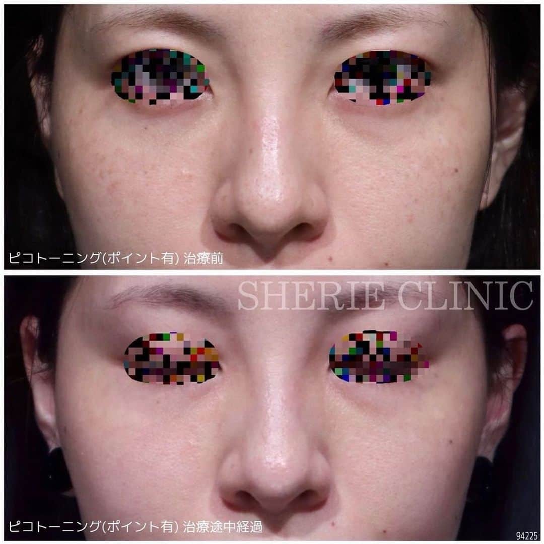 岩城まりこさんのインスタグラム写真 - (岩城まりこInstagram)「入社した看護師のテストで何ヶ月かピコトーニング受けた💆‍♀️✨ やぱピコ受けると肌が艶々になるわぁ （めっちゃアプリで肌光らせてるだけ ⁡ 同じ機械でも施術方法で効果は全然違ってくるからね🌸 ⁡ そして当院では厳しいテストを合格した看護師しか施術させておりません🙅‍♀️ 入社して何ヶ月もピコトーニングやダーマペン施術に入れない看護師もざらにいます。　 ⁡ それだけ、通ってくださっている方には満足してもらえるように、こだわってやってます🍀 ⁡ ⁡ ⁡ ⁡ ⁡ 💉ピコトーニング ⚠️ 赤み・点状出血・膨隆疹・白斑など 💰¥9,800（税込¥10,780）初回のみ ⁡ 🏥SHERIE CLINIC新宿本院 📍東京都新宿区歌舞伎町2-26-10-4F 📱クリニックアカウント @sherie_clinic  ⁡ 🏥SHERIE CLINIC福岡院 📍福岡県福岡市中央区天神2-7-14-4F 📱クリニックアカウント @sherie_fukuoka ⁡ ⁡ #育児日記 #赤ちゃんのいる生活 #新米ママ #ベビスタグラム #ig_baby #男の子ママ #女の子ママ #育児記録 #ママライフ #ママさん #働くママ #女社長 #女性社長 #キャリアウーマン #社長 #経営者 #マタニティーライフ #妊婦生活 #マタニティーコーデ #働く女性 #ママコーディネート #ママと息子 #ママ友募集  #美容 #新宿 #ナース #美容ナース #看護師 #美容看護師 #求人」2月28日 22時21分 - mariko_iwaki