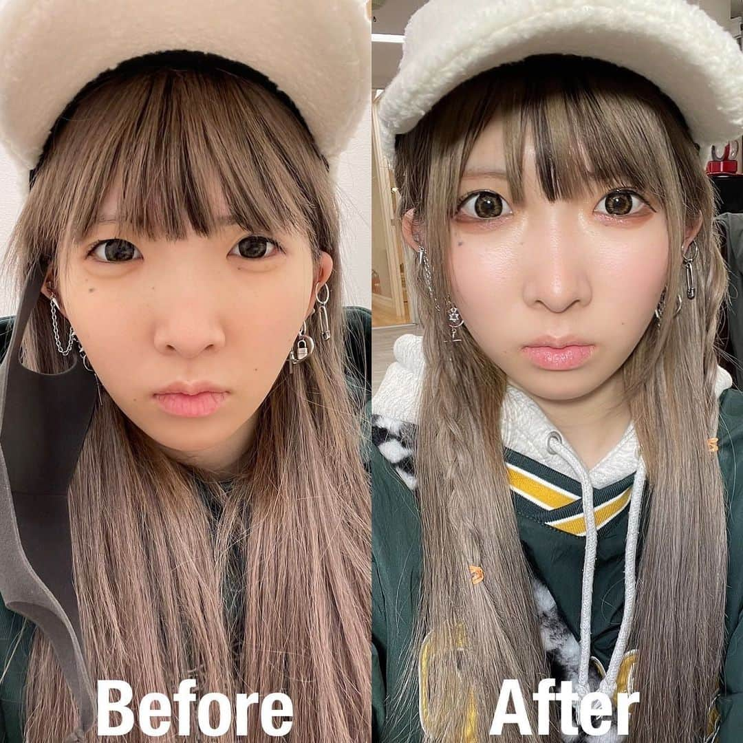 まあたそさんのインスタグラム写真 - (まあたそInstagram)「A CLINICの(@a_clinic_ginza)の田窪先生 (@aclinic_takubo)でAスレッド受けきた👶  輪郭のたるみ気になっとってデザイン次第で丸顔っぽくもしてくれて大満足🍥 明らかに顔変わりました！ってより、なんか顔シュッとしたな！💭って感じで凄い自然！ 痛いの嫌だ！ってわがまま言ったらちゃんと麻酔してくれたから全く痛み感じず秒でおわったw  凄い丁寧に相談聞いてくれて理想像に近付けてくれたから絶対また田窪先生お願いしたい🥺  #aスレッド #糸リフト #aclinic #aclinic銀座 #aclinic横浜 #aclinic新宿 #aクリニック #エークリニック#美容 #小顔 #美肌 #リフトアップ #美容外科 #美容皮膚科 #美容クリニック #田窪賢志郎」3月16日 9時32分 - 5m91r