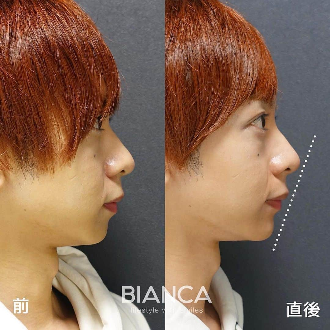 辻沢由有（BIANCA CLNIC 表参道院 院長）さんのインスタグラム写真 - (辻沢由有（BIANCA CLNIC 表参道院 院長）Instagram)「#dryuuヒアル ▶︎swipeでBefore/After❤︎▶︎  イケメンが更にイケメンに✨ 男性にも大人気です❣️ 横顔がかなり綺麗になります✨  ヒアルロン酸はデザインが命です💉💓 お悩みを是非 お聞かせください✨  🌸鼻翼基部ヒアルロン酸 💉 Juvederm VOLUMA 1ml 🌸顎ヒアルロン酸 💉 Juvederm VOLUX 1ml 💴製剤料 77,000円/ml  🌸鼻筋〜鼻先ヒアルロン酸 💉 Juvederm VOLUX 1ml 💴製剤料107,800円 /ml  別途 ヒアルロン酸施術料 22,000円  ⏳治療時間: 10分 🗓持続期間: 1〜2年 😷腫れ・内出血: 数日程度 ⚠️リスク: 感染・血流障害・凹凸など  ⚠️ご予約の際は 『ゆう先生（辻沢）のインスタ見た』の一言をお願いします👩‍⚕️✨ 📍BIANCA CLINIC ✔︎表参道院 03-6433-5994 東京都港区南青山5-11-10  南青山511ビル 2F ✔︎銀座院 03-6263-2690  東京都中央区銀座1-5-6 銀座レンガ通り福神ビル 4F 診療時間 10:00〜19:00 年中無休（年末年始を除く）  #美容好き#プチ整形 #美容好きな人と繋がりたい#貴族手術 #綺麗になりたい #美容皮膚科 #貴族フィラー #cosmeticsurgery #plasticsurgery #biancaclinic #ビアンカクリニック #貴族注射 #followｍe #フォローミー #顎ヒアルロン酸#Eライン#モニター募集 #モニター募集中 #リップヒアルロン酸 #小顔整形  #鼻先ヒアルロン酸#鼻ヒアルロン酸#鼻整形#鼻尖形成」3月24日 13時09分 - i_am_yuu__