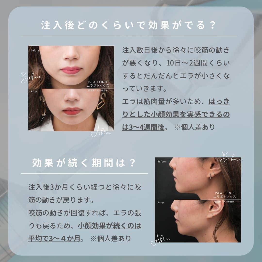 東京イセアクリニックさんのインスタグラム写真 - (東京イセアクリニックInstagram)「💉エラボトックス徹底解説💉  「小顔治療」の1つとして知られている エラボトックスについて💡  その効果や持続期間 副作用・よくある質問などをまとめました。  参考にしてみてください👩🏻‍⚕️👨🏻‍⚕️🧑🏻‍⚕️  ＝＝＝＝ 画像内症例 ▶ 担当医：大山希里子　@kiriko_isea  ＝＝＝＝  ■イセアのエラボトックス　※税込表示  ボツラックス・・・両側：66,000円　／　片側：44,000円 ボトックス・・・・両側：77,000円　／　片側：55,000円  ＝＝＝＝  #イセアクリニック #ISEACLINIC #イセア #新宿　#小顔 #小顔治療 #ボトックス #エラボトックス #小顔ボトックス #ハイフ #医療ハイフ  #スレッドリフト #たるみ #骨切り #脂肪吸引 #バッカルファット #美容 #整形 #美容整形 #美容皮膚科」3月28日 15時52分 - iseaclinic