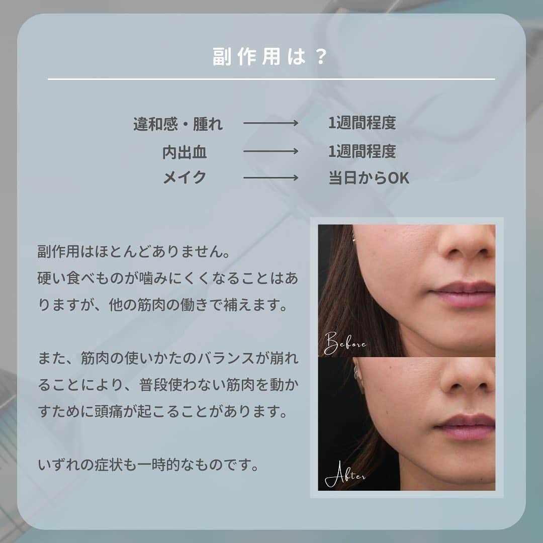 東京イセアクリニックさんのインスタグラム写真 - (東京イセアクリニックInstagram)「💉エラボトックス徹底解説💉  「小顔治療」の1つとして知られている エラボトックスについて💡  その効果や持続期間 副作用・よくある質問などをまとめました。  参考にしてみてください👩🏻‍⚕️👨🏻‍⚕️🧑🏻‍⚕️  ＝＝＝＝ 画像内症例 ▶ 担当医：大山希里子　@kiriko_isea  ＝＝＝＝  ■イセアのエラボトックス　※税込表示  ボツラックス・・・両側：66,000円　／　片側：44,000円 ボトックス・・・・両側：77,000円　／　片側：55,000円  ＝＝＝＝  #イセアクリニック #ISEACLINIC #イセア #新宿　#小顔 #小顔治療 #ボトックス #エラボトックス #小顔ボトックス #ハイフ #医療ハイフ  #スレッドリフト #たるみ #骨切り #脂肪吸引 #バッカルファット #美容 #整形 #美容整形 #美容皮膚科」3月28日 15時52分 - iseaclinic