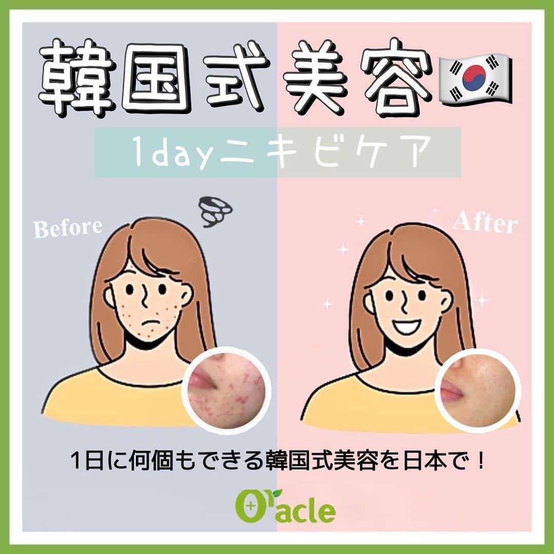 オラクル美容皮膚科東京新宿院さんのインスタグラム写真 - (オラクル美容皮膚科東京新宿院Instagram)「⁡⚠️ニキビの治療は回数が必要です。1日で改善するという内容ではございません。  🇰🇷韓国式1day治療 最近、韓国アイドルが日本でのイベントを発表したり 実際に日本に来てくれたりと うれしい発表が多く一般の人たちも韓国旅行に行ける日が近づいてきている気がします🥺 ⁡ 早く韓国で美活もしたいところですが、、、 まだ具体的にいつ行けるかはわからないですよねㅜㅜ  ですが！日本で韓国式美容できます！ オラクルで韓国式美容を行いませんか？🥰 ⁡ 🇰🇷韓国式美容とは🇰🇷 韓国式の肌管理&1日で複数治療の組み合わせ のこと。  ❤︎ダウンタイムを軽減→鎮静ケア ❤︎施術の効果をアップ→1日に複数組み合わせ  日本のオラクルでは韓国式の肌管理をされている方が多いです。 ⁡ ⁡🇰🇷1day🇰🇷 1日でできる韓国式肌管理 ❣️その名も【1dayニキビケア】をご紹介❣️  👉例えば ✅アクアピーリング(毛穴洗浄) ＋ ✅ジェネシス(レーザー) ＋ ✅シルファームX(マイクロニードルRF) ＋ ✅鎮静管理(冷却エレクトロポレーション) ＋ ✅ゴムマスク(韓国式モデリングマスク) ⁡ このような施術が1日でできちゃいます✨ ⁡ +-+-+-+-+-+-+-+-+-+-+-+-+-+ ⁡ 【料金】※すべて税込 ホームページには出ていませんが セットにした場合は院内で割引を行っております💓  詳しくはスタッフまでお問合せください✨ ⁡ ⁡ ❤︎アグネス 　[片側] 顎、頬、こめかみ　[1箇所] 鼻1回	22,000円　  ❤︎美白管理　1回11,000円  ❤︎韓国式ゴムマスク　1回11,000円  ❤︎BHAピーリング　1回11,000円  ❤︎ジェネシス　1回11,000円　 ※新宿・大阪梅田・福岡天神院のみ  ❤︎メソナJ赤ら顔コース　1回19,800円  ❤︎シルファームX　1回25,000円 　▶︎CICAマスク　1回3,300円　※お持ち帰りも可能です  ❤︎アクアピーリング　1回11,000円  ❤︎フラクセル&ピコフラクショナルは全て同じ料金　 顔1回19,800円　部分1回(鼻目安) 7,920円  ❤︎鎮静管理　1回11,000円 ⁡ ※BHAピーリングと鎮静管理、美白管理には韓国式ゴムマスクもついてきます！ その他の施術のオプションの場合は11,000円 ※圧出は単品での施術は行っておりません。 ⁡ ⁡ ⁡ #オラクル美容皮膚科 #オラクル #𝗈𝗋𝖺𝖼𝗅𝖾 #韓国美容 #美容皮膚科 #皮膚科 #美容 #ピコレーザー #フラクセル #cica #美容オタク #ツヤ肌 #弾力 #モデリングマスク #エイジングケア #シルファームx #일본피부과 #오라클피부과 #韓国好き #美肌 #韓国美容 #肌管理 #韓国美容皮膚科 #エレクトロポレーション #メソナj #アクアピーリング #ジェネシス #アグネス #韓国式美容 #ニキビ #ニキビ跡」3月28日 16時44分 - oraclejp