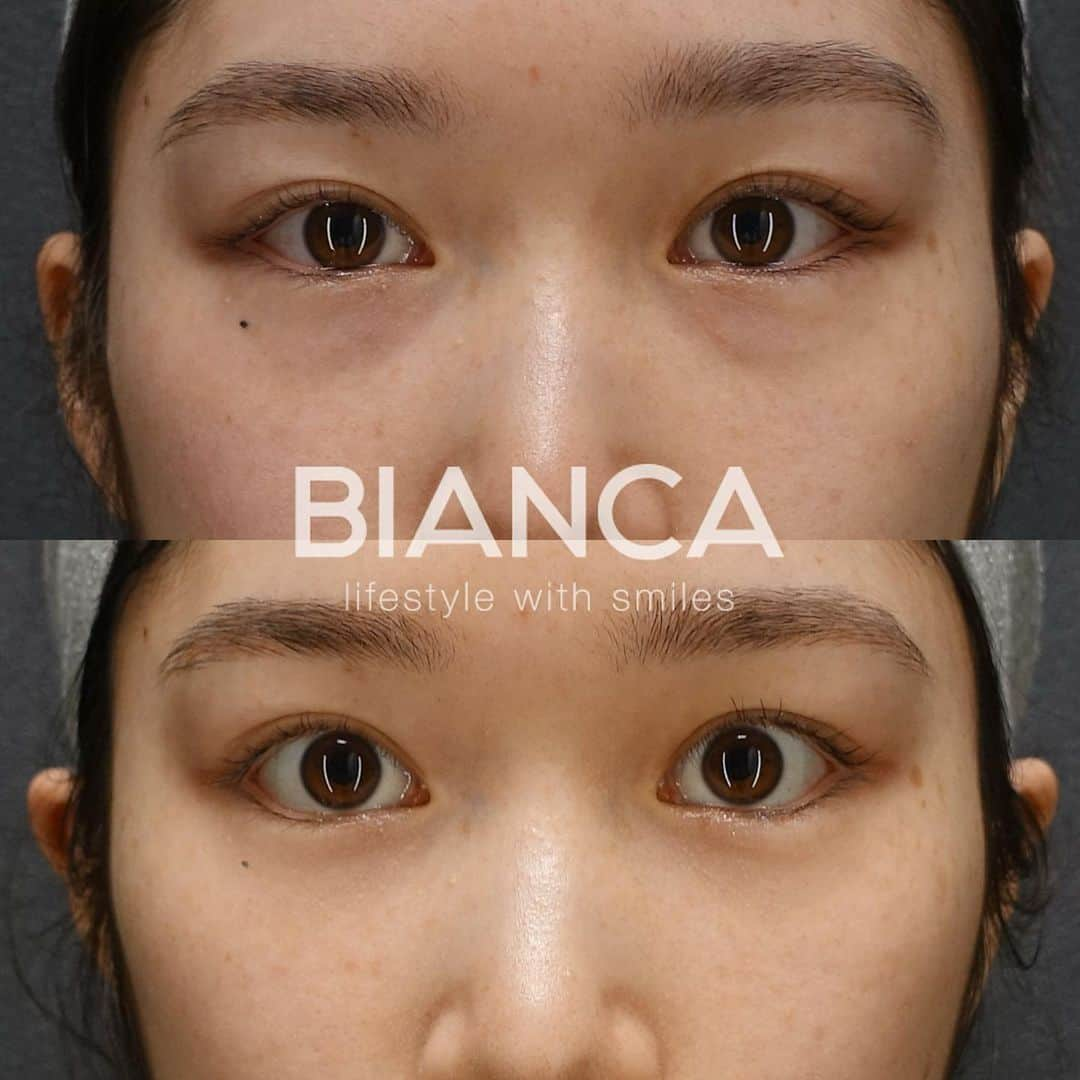 辻沢由有（BIANCA CLNIC 表参道院 院長）さんのインスタグラム写真 - (辻沢由有（BIANCA CLNIC 表参道院 院長）Instagram)「#dryuu目 【目元フル】で、一気に華やかに🌸  ✔︎目の下のクマをなくし ✔︎グラマラスラインで自然な目元のカーブと大きさを❤️  あくまでわざとらしくなく、ぱっと見の印象も プラスに変化しましたね🥰❤️  ▶︎価格 ✔︎グラマラスライン形成（下眼瞼下制術） 　税込382,800円 ✔︎脱脂　税込327,800円  ▶︎ダウンタイム 　腫れ 内出血:数日〜1週間程度  ⚠️ご予約の際は、『ゆう先生のインスタ見た』 の一言をお願いします👩‍⚕️✨  📍BIANCA CLINIC  ✔︎表参道院 03-6433-5994 東京都港区南青山5-11-10  南青山511ビル 2F ✔︎銀座院 03-6263-2690  東京都中央区銀座1-5-6 銀座レンガ通り福神ビル 4F 診療時間 10:00～19:00 年中無休（年末年始を除く）  #グラマラスライン#グラマラスライン形成 #脱脂#目の下のクマ #目の下のたるみ取り #二重#二重整形 #タッキング#眼瞼下垂 #眼瞼下垂手術 #タッキング法 #コンデンスリッチフェイス #脂肪注入#タレ目#タレ目形成」3月30日 14時53分 - i_am_yuu__