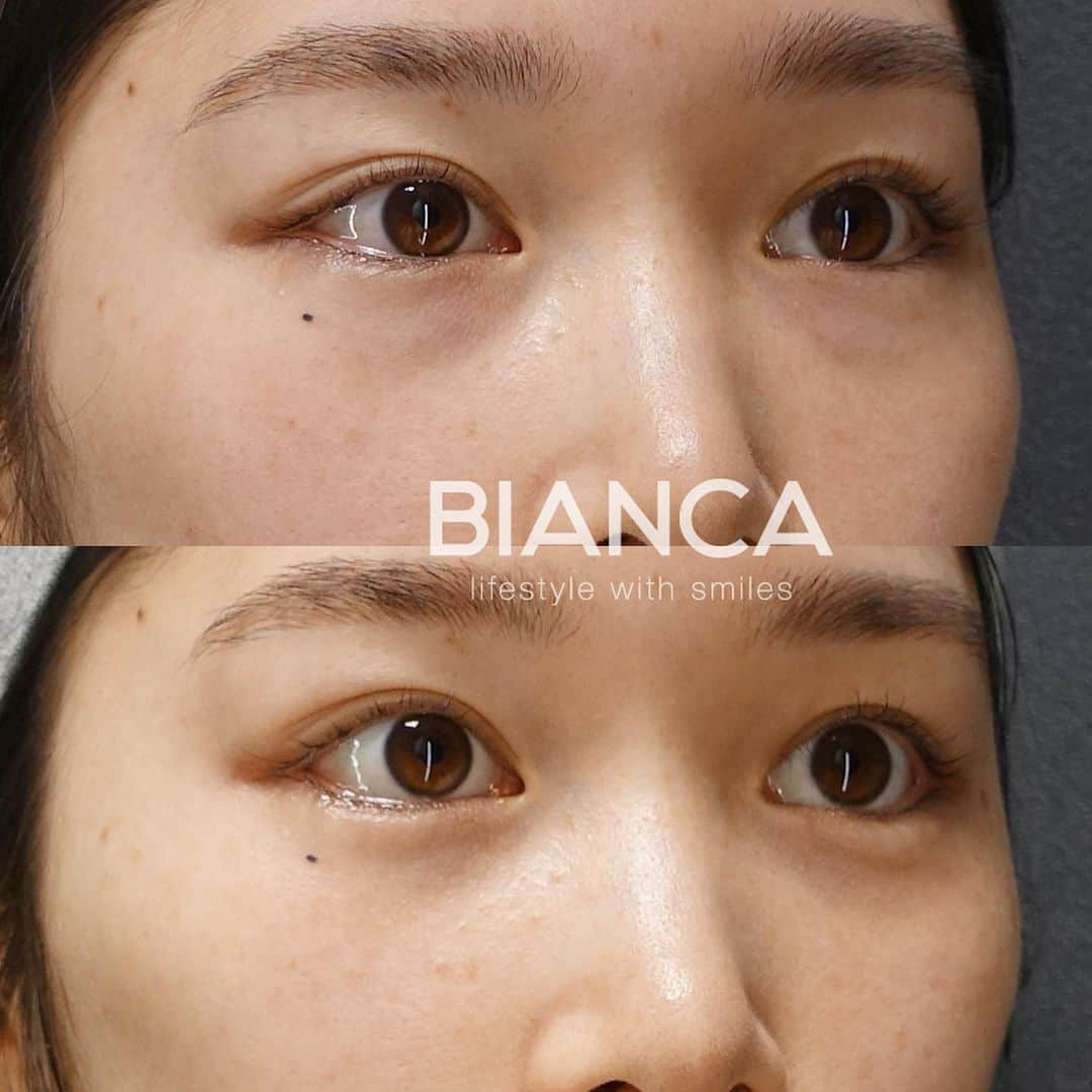 辻沢由有（BIANCA CLNIC 表参道院 院長）さんのインスタグラム写真 - (辻沢由有（BIANCA CLNIC 表参道院 院長）Instagram)「#dryuu目 【目元フル】で、一気に華やかに🌸  ✔︎目の下のクマをなくし ✔︎グラマラスラインで自然な目元のカーブと大きさを❤️  あくまでわざとらしくなく、ぱっと見の印象も プラスに変化しましたね🥰❤️  ▶︎価格 ✔︎グラマラスライン形成（下眼瞼下制術） 　税込382,800円 ✔︎脱脂　税込327,800円  ▶︎ダウンタイム 　腫れ 内出血:数日〜1週間程度  ⚠️ご予約の際は、『ゆう先生のインスタ見た』 の一言をお願いします👩‍⚕️✨  📍BIANCA CLINIC  ✔︎表参道院 03-6433-5994 東京都港区南青山5-11-10  南青山511ビル 2F ✔︎銀座院 03-6263-2690  東京都中央区銀座1-5-6 銀座レンガ通り福神ビル 4F 診療時間 10:00～19:00 年中無休（年末年始を除く）  #グラマラスライン#グラマラスライン形成 #脱脂#目の下のクマ #目の下のたるみ取り #二重#二重整形 #タッキング#眼瞼下垂 #眼瞼下垂手術 #タッキング法 #コンデンスリッチフェイス #脂肪注入#タレ目#タレ目形成」3月30日 14時53分 - i_am_yuu__