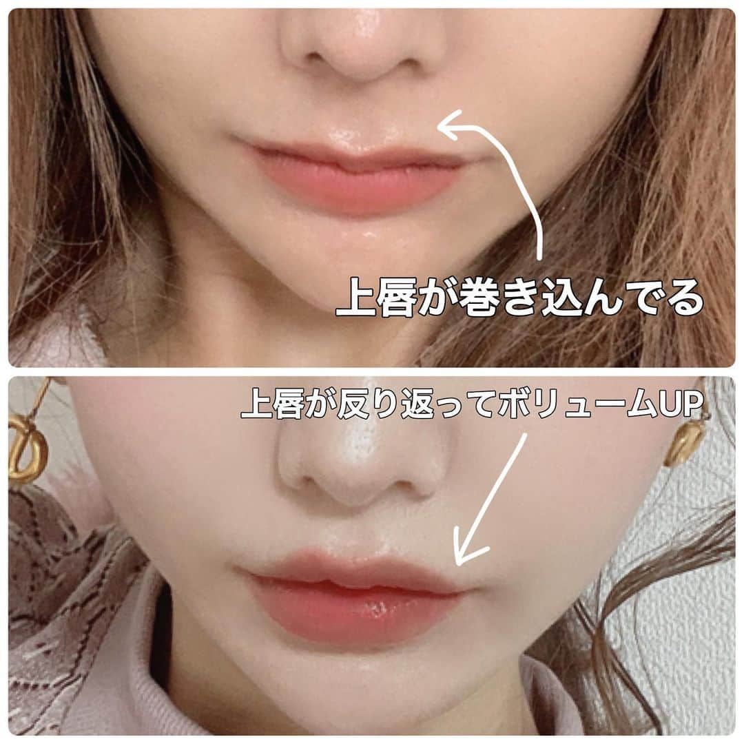 吉川ちえさんのインスタグラム写真 - (吉川ちえInstagram)「【👃👄👃👄👃👄】 . 人中短縮ボトックス打って数ヶ月経ったので経過レポ✍️💓 . 人中短縮ボトックス注射💉とは、 口輪筋（口の周りの筋肉）に 注入する施術の事だよ😘❤️ . 私は年齢や骨切り手術のせいで、 唇が内側に巻き込まれ唇が薄く見えてしまって人中が長く見えてしまってたの😵‍💫💔 . ボトックスを口輪筋に注入して筋肉を緩まると唇が反り返って☝️上を向くようになりました🧸🎀 私にはかなり向いてた施術でした😉🙌🏻💕 . 写真はbeforeが人中短縮ボトックスする前で afterが人中短縮ボトックス2回目🙈❤️❤️ めっちゃ唇の薄さが無くなって嬉しい😍💓 . 2回どちらも注射はレジュバの れな先生👧🏻( @drrena.a )に お願いしました🥺🧡🧡 ついでに顎ボトックスも打って顎の梅干しも無くしました😆✨ . れな先生のおかげで私の巻き込み唇 復活しました💓🙏感謝❤️ . ★人中ボトックス★ 価格💰¥30000 . 🏥表参道レジュバメディカルクリニック🏥 📮東京都港区南青山3丁目7番地19 📞03-6434-7323 🚃東京メトロ銀座線・千代田線・半蔵門線【表参道駅A4出口】徒歩６分 . #レジュバクリニック #表参道レジュバメディカルクリニック  #人中短縮ボトックス #人中短縮 #ボトックス #ボトックス注射」3月31日 22時08分 - yoshikawachie_16