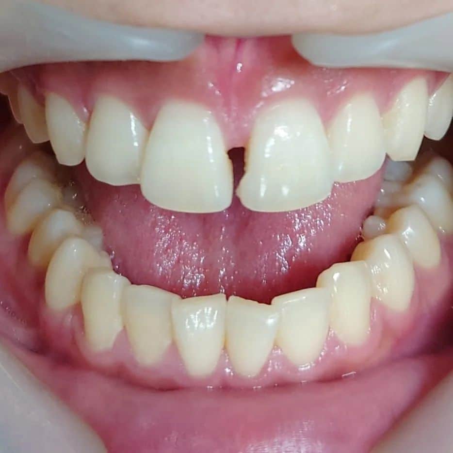 五十嵐一誠さんのインスタグラム写真 - (五十嵐一誠Instagram)「こんなすきっ歯を 歯を全く削らないで直す方法が あるんです ２ページ目を見てください  レジンを使って両側の歯に 接着して作ります  耐用年数は人によって違いますが１年〜３年  料金　33000円（税込）  所要時間　３０分  #五十嵐歯科クリニック六本木 #すきっ歯 #歯医者#矯正 #歯 #ホワイトニング#歯並び#歯科 #審美歯科#エステ#ヨガ#美容 #整形#フィットネス#yoga」4月1日 7時00分 - superdentist5