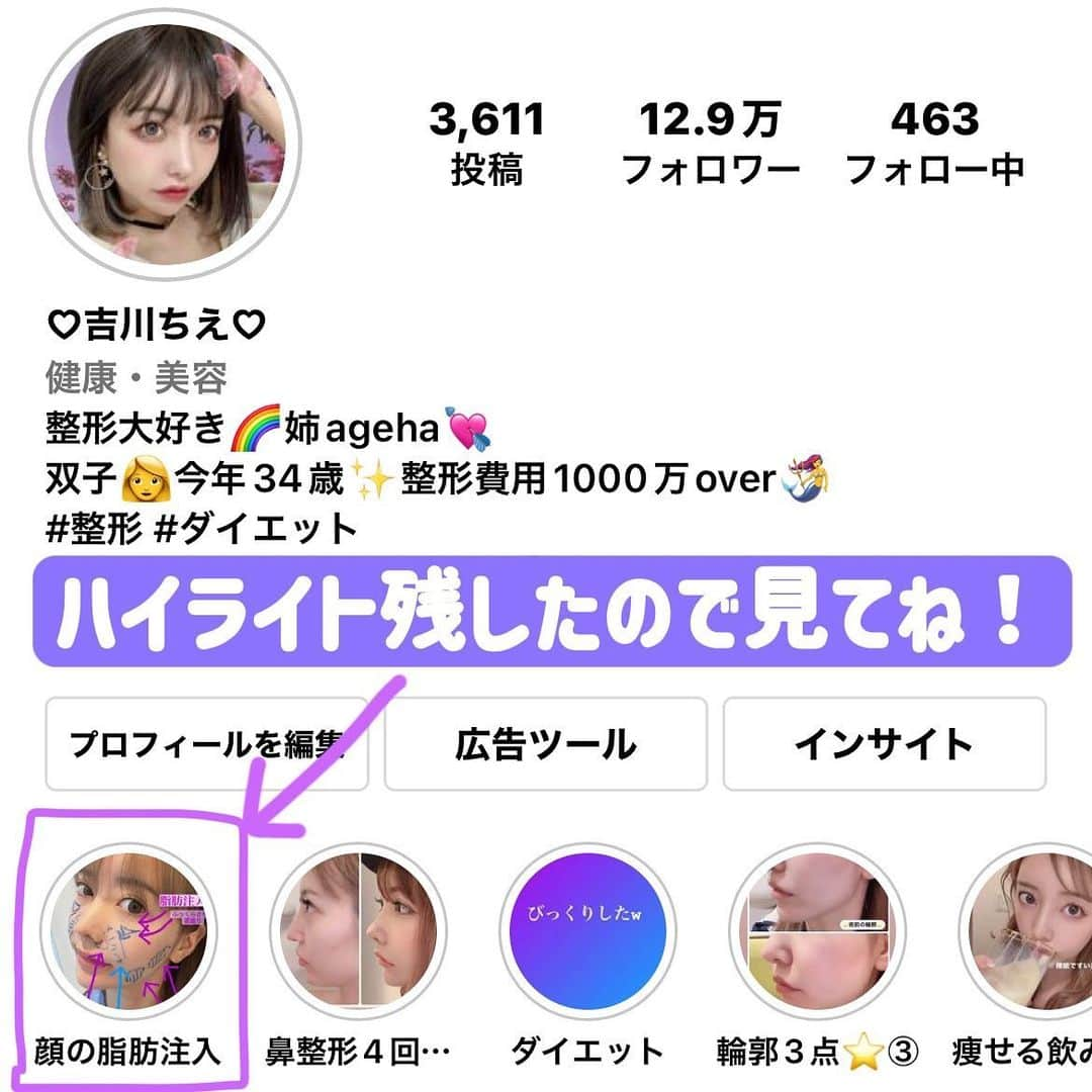 吉川ちえさんのインスタグラム写真 - (吉川ちえInstagram)「【整形してきました💉🏥】 . 今回はアンチエイジングの為に顔の ✅ほうれい線上脂肪吸引 ✅痩けてる部分に脂肪注入 . をしてきました😘💓太ももとひざ上から 脂肪採取して顔に移動させました👏笑 ボリュームいらない所は無くして ボリューム欲しい所に足すって感じの整形です🙈❤️ 顔のパーツが今回変わる訳じゃなくて若返り✨希望の整形です🎀 . 私は最近顔の痩け(頬に変な線が入る)のが悩みでそれを1番改善したいのと、 ずっと悩みであるほうれい線改善の為に今回整形しました😋🤞❣️ . まだまだダウンタイム中で顔にテーピング貼ったままなので大変ですが 残りのダウンタイム頑張って乗り越えようと思います😙🧡 . ダウンタイムの様子やリアルタイムはプロフィールの "顔の脂肪注入"のハイライトに残してあるので見てください😊‼️ . またダウンタイム終わったら経過レポしますね😍その時成功してたら病院や先生もUPします💓 . #整形 #美容整形 #整形ダウンタイム #ダウンタイム #ダウンタイム経過 #脂肪注入 #脂肪吸引 #鼻翼基部  #ほうれい線 #ほうれい線改善  #ほうれい線解消 #頬の痩け #アンチエイジング」4月16日 23時18分 - yoshikawachie_16