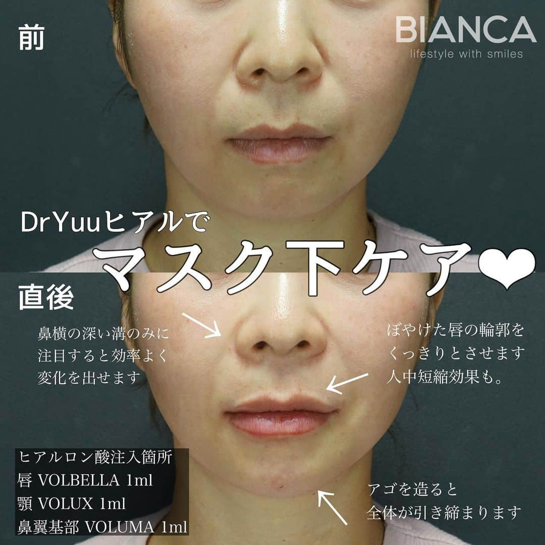 辻沢由有（BIANCA CLNIC 表参道院 院長）さんのインスタグラム写真 - (辻沢由有（BIANCA CLNIC 表参道院 院長）Instagram)「#dryuuヒアル ▶︎swipeで別角度&文字無し写真▶︎  そろそろ脱マスク😷♡  マスク下のケアも始めましょう❣️ ヒアルロン酸は技術はもちろんですが、デザインが命です💉💓 お悩みを是非 お聞かせください✨  🌸唇ヒアルロン酸 💉 Juvederm VOLBELLA 1ml 　　77,000円 🌸顎ヒアルロン酸 💉 Juvederm VOLUX 1ml 　　77,000円 🌸鼻翼基部ヒアルロン酸 💉 Juvederm VOLUMA 1ml 　　77,000円 別途 ヒアルロン酸施術料 22,000円  ⏳治療時間: 10分 🗓持続期間: 1〜2年 😷腫れ・内出血: 数日程度 ⚠️リスク: 感染・血流障害・凹凸など  🉐モニター募集中💡💓 ⚠️ご予約の際は 『ゆう先生のインスタ見た』の一言をお願いします👩‍⚕️✨ 📍BIANCA CLINIC ✔︎表参道院 03-6433-5994 東京都港区南青山5-11-10  南青山511ビル 2F ✔︎銀座院 03-6263-2690  東京都中央区銀座1-5-6 銀座レンガ通り福神ビル 4F 診療時間 10:00〜19:00 年中無休（年末年始を除く）  #美容好き#プチ整形 #美容好きな人と繋がりたい#唇ヒアルロン酸#綺麗になりたい #美容皮膚科 #美容外科 #cosmeticsurgery #plasticsurgery #biancaclinic #ビアンカクリニック #貴族フィラー #followｍe #鼻翼基部ヒアルロン酸 #顎ヒアルロン酸#Eライン#モニター募集 #モニター募集中 #リップヒアルロン酸 #小顔整形  #鼻先ヒアルロン酸#鼻ヒアルロン酸#鼻整形#貴族手術」5月12日 9時36分 - i_am_yuu__