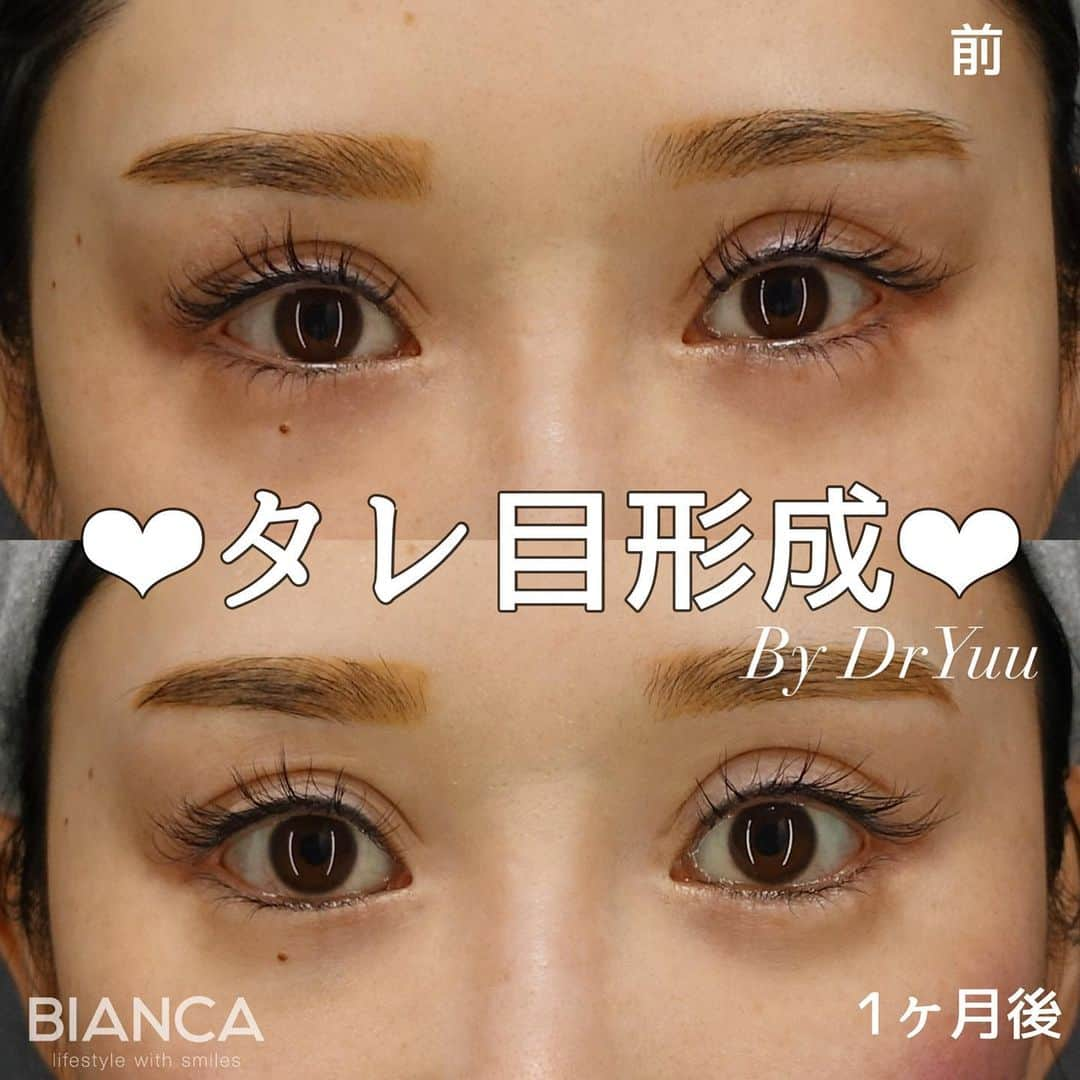 辻沢由有（BIANCA CLNIC 表参道院 院長）さんのインスタグラム写真 - (辻沢由有（BIANCA CLNIC 表参道院 院長）Instagram)「#dryuu目 ▶︎swipeで文字なし＆別角度症例写真▶︎  グラマラスラインで自然な目元のカーブと大きさを❤️  あくまでわざとらしくなく、ぱっと見の印象も プラスに変化しましたね🥰❤️  ▶︎価格 ✔︎グラマラスライン形成（下眼瞼下制術） 　税込382,800円  ▶︎ダウンタイム 　腫れ 内出血:数日〜1週間程度  ⚠️ご予約の際は、『ゆう先生のインスタ見た』 の一言をお願いします👩‍⚕️✨  📍BIANCA CLINIC  ✔︎表参道院 03-6433-5994 東京都港区南青山5-11-10  南青山511ビル 2F ✔︎銀座院 03-6263-2690  東京都中央区銀座1-5-6 銀座レンガ通り福神ビル 4F 診療時間 10:00～19:00 年中無休（年末年始を除く）  #グラマラスライン#グラマラスライン形成 #脱脂#目の下のクマ #目の下のたるみ取り #二重#二重整形 #タッキング#眼瞼下垂 #眼瞼下垂手術 #タッキング法 #コンデンスリッチフェイス #脂肪注入#タレ目#タレ目形成」5月13日 16時48分 - i_am_yuu__