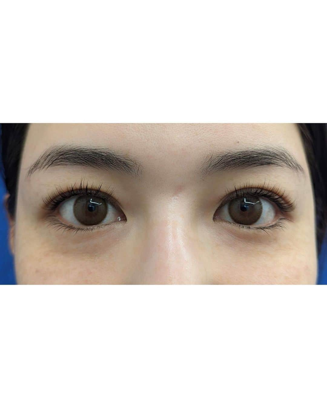 石井里奈さんのインスタグラム写真 - (石井里奈Instagram)「こんばんは💕 今日は美容投稿👁 ちょうど1ヶ月前にやったクマ取りについて✏️✨ ずっと気になってた目の下のクマ。 膨らみあるからコンシーラーでも消えにくいし老けて見えるし、疲れ顔に見えるしずっと気になってて！ . 写真ではよく加工して消してたから笑あんまり違いがわからない！っ方もいるかもしれないけど特にひどい時の無加工写真最後につけてます🤔📸 . いろいろリサーチして友達にも相談して、絶大的な信頼度があった @sbc_yanagawa に今回お願いしました👏 本当に丁寧なカウンセリングでひとつひとつ不安を解消してくれて✨ ただいざ手術ってなるとすごく怖かったけど看護師さんもみんな優しくて応援してくれて、無事に成功💛 内出血することもなく腫れも最小限！3日後くらいが1番腫れたかな？でも全然メイクしたら翌日からでも外に出れるくらい👁 私はクマ取りだけだけど本当は脂肪も入れた方が綺麗に仕上がるらしい！けど私は一旦ダウンタイムもそんな取れないと思って、とるだけに❣️ . ストーリーズでもかなりDMきてて、きっとクマ取り迷ってる子もたくさんいると思うのでこの投稿が少しでも役に立ちますように❤️ 私的にはすごくスッキリしたし、やってよかったです✨ やな先生ありがとうございました😊 . #クマ取り #クマ #クマ取りダウンタイム #若返り #若返り美容 #若返りたい #美容整形 #美容整形外科 #湘南美容クリニック #sbc #整形 #beforeafter #ダウンタイム #目の下のクマ #目の下のたるみ取り #目の下のたるみ #目の下の切らないたるみ取り #疲れ顔 #メイク #大人メイク #アンチエイジング #たるみ改善 #たるみ #美容 #beauty #美容医療 #美容好き #美容女子 #beautytips #japamesebeauty」5月21日 19時47分 - ri7tin1025