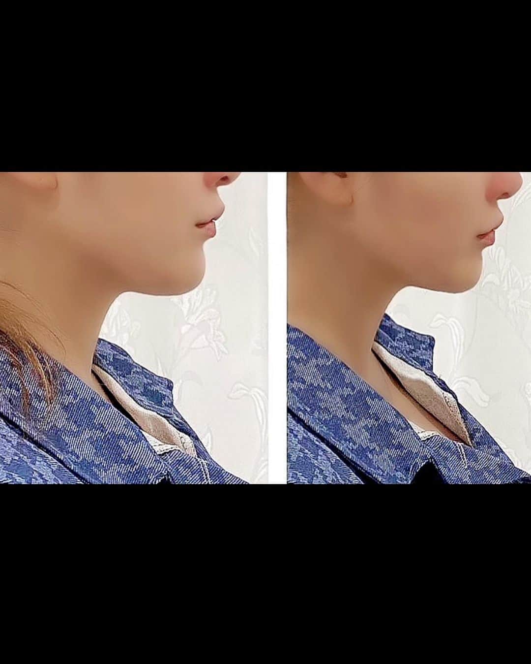 リアラさんのインスタグラム写真 - (リアラInstagram)「再来週は大事な大事な撮影！！  顔少しでもキュッとしたくて、 都内初導入のウルトラ12DHIFUを受けてきた🔥  大体のところは3D、４Dが主流ですが、ここは12Dでばちばち強度強めにやってもらった✨ 私痛みに強いので美しくなる為なら痛いのはなんでも我慢出来るけど、凄く腕のいい担当さんで気持ちよくて寝落ちしてた…  顔、ボディどちらもショット数無制限です✨  リアラのインスタ見た！で 通常128,000円→初回9,800円でご体験頂けるそうです💛  12万円引きはあり得ない価格かと思うので一度でもやってみたい方は是非✨ ２枚目にビフォーアフター載せてます、デフォルトカメラです。  二重顎の違いを1時間で変えれるなら買った方がいい。 #美はお金で買える時代。  @byousokukogao_shinjuku  #撮影#宣材#宣材写真#水着#筋トレ#筋肉#腸腰筋#胸トレ#gcup#ハイフ#ウルトラハイフ#エステ#美容#fifu#12d#エステサロン#可愛くなりたい#若返り#アンチエイジング#小顔#歌舞伎町#新宿#キャバ嬢#キャバクラ#リアラ」5月28日 22時25分 - riaranyan