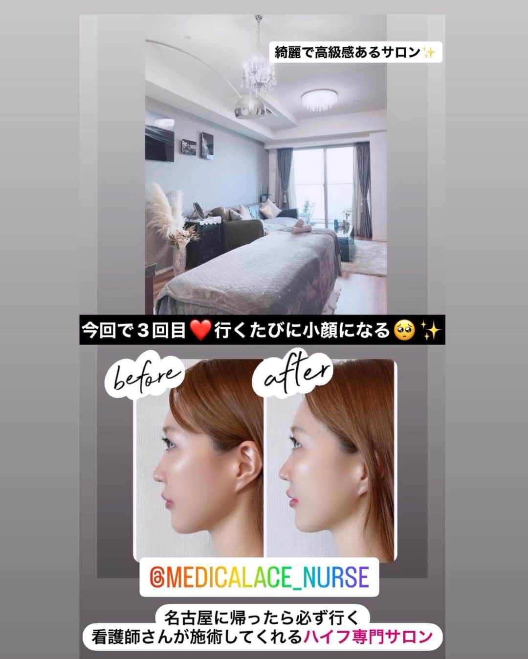 おりささんのインスタグラム写真 - (おりさInstagram)「💛名古屋  @medicalace_nurse   施術歴1万人以上の看護師さんがやってる ハイフ専門サロン  メディカルエース( @medicalace_nurse )  小顔になるだけじゃなくて 目の上や細かい部分も施術してくれるから むくみが取れて目や鼻も変わる！✨感動✨  顔のトーンもパッと明るくなって 化粧ノリも良くなるよ🙆‍♂️  美容皮膚科の1/4の価格でできてお得💕  おりさは3回目のリピートです❤️  -------------------------------------  🔻おりさの紹介で  ピーリング(通常5000円)と 炭酸ガスパック(通常1000円)サービス  紹介したお友達も効果に感動して リピーターになってた❤️  #medicalace#medicalace_nurse#okinawa#okinawajapan#bikinigirl#beach#bikinigirl#sea#okinawa#名古屋#名古屋エステ#エステ#美容#ピーリング#小顔##看護師ハイフサロン#看護師エステ#ハイフ専門サロン#プライベートサロン#メディカルエース#メディカルエース名古屋#沖縄#沖縄旅行#沖縄生活#沖縄移住#女子旅#タビジョ#麦わら帽子#ビキニコーデ#水着コーデ#リゾート」9月6日 0時10分 - orisa_0510