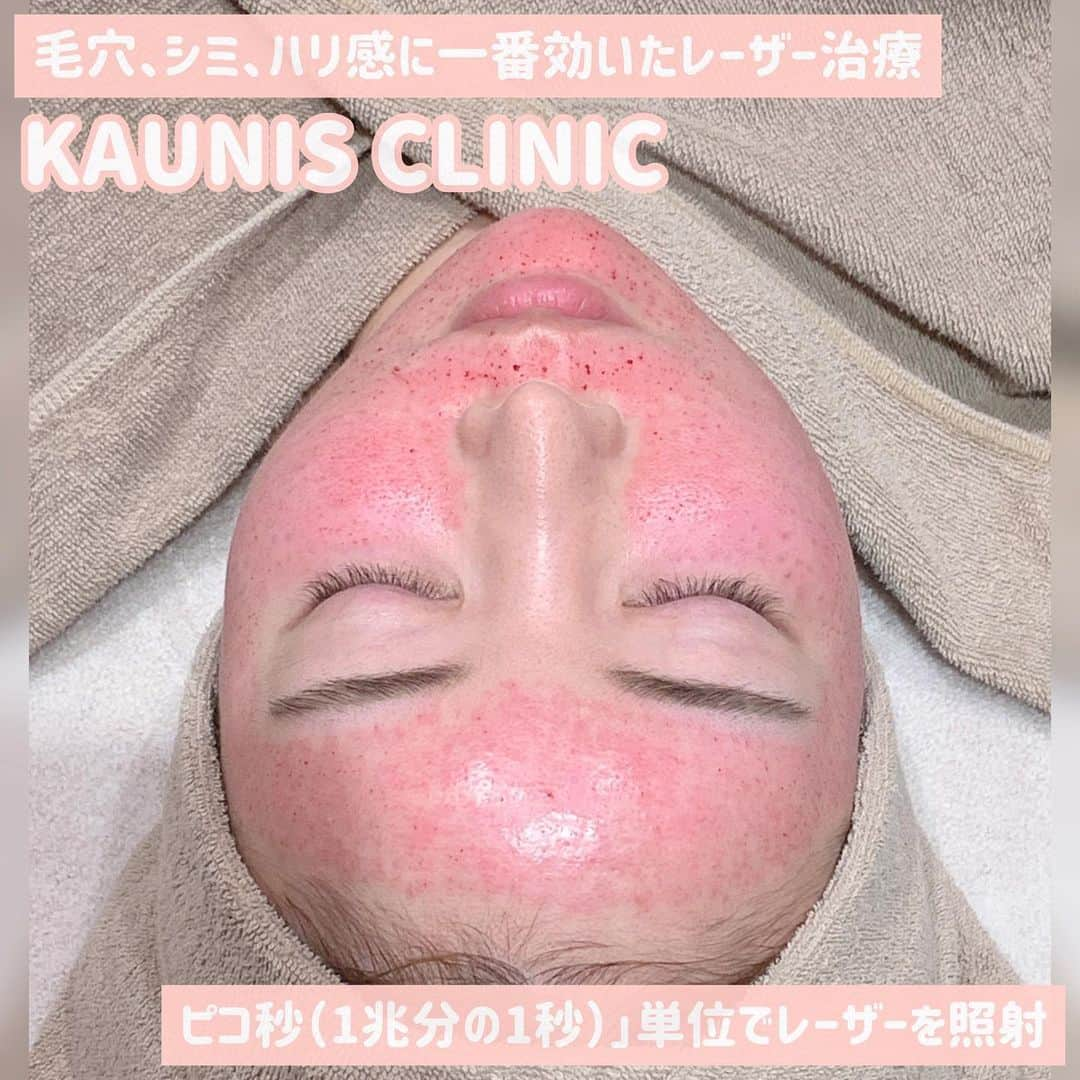 吉川ちかさんのインスタグラム写真 - (吉川ちかInstagram)「先月KAUNISクリニック (@kaunis_clinic )で ピコフラクショナルレーザーと ピコスポット(シミ取り)したよ🥹💓  ちえがお肌別人のように 綺麗になってたから 私もやりたくて、施術してきたよ🤌💕  先に顔に麻酔クリームを塗るからレーザーの時も 痛くなかったし楽勝でした🤣💓  ピコスポット(スポットシミ、そばかす、ホクロ、あざ)   お顔の気になるシミを1個1個治療してくの！ 一回で私は大満足でした✌️💓 綺麗に取れました！  ピコフラクショナルは(小じわ、ニキビ跡、毛穴の開き、くすみ、美白) に良く 肌が見違える程綺麗になった🥹💕  ダウンタイムはありますが、 肌治療した中で断トツで ピコフラクショナルレーザーが最強でした🤣💓  ちなみに肌年齢24歳になりましたw こんな素晴らしい施術 もっと早くすればよかったです🤌💕泣  また今月もやりますw  #ピコフラクショナルレーザー#ピコフラクショナル#ピコフラ#ピコスポット#シミ取り#シミ#毛穴#美肌#肌管理#美肌ケア#肌年齢」9月14日 19時00分 - yoshikawachika_1116