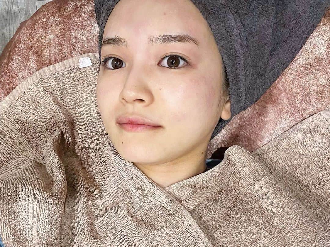 富久美玲さんのインスタグラム写真 - (富久美玲Instagram)「_ . 今回ついに・・・！ . 鼻にあったソバカスとおさらば👃👋 . 1枚目▷施術後1週間経った今日！ 写真では分からない程に薄くなりました🥺  2枚目▷施術前  3枚目▷施術後(赤くかぶれました)  4枚目▷施術後3日が経ったぐらいから 赤みとかぶれも引いたのと同時にポロッと ソバカスが取れて薄くなってました✨ . 施術内容は フォトフェイシャルのルメッカ ➕高濃度ビタミンC点滴 . 担当:工藤ナース . #表参道メディカルクリニック#フォトフェイシャル#ルメッカ#高濃度ビタミンC点滴」9月22日 22時49分 - mirei_official