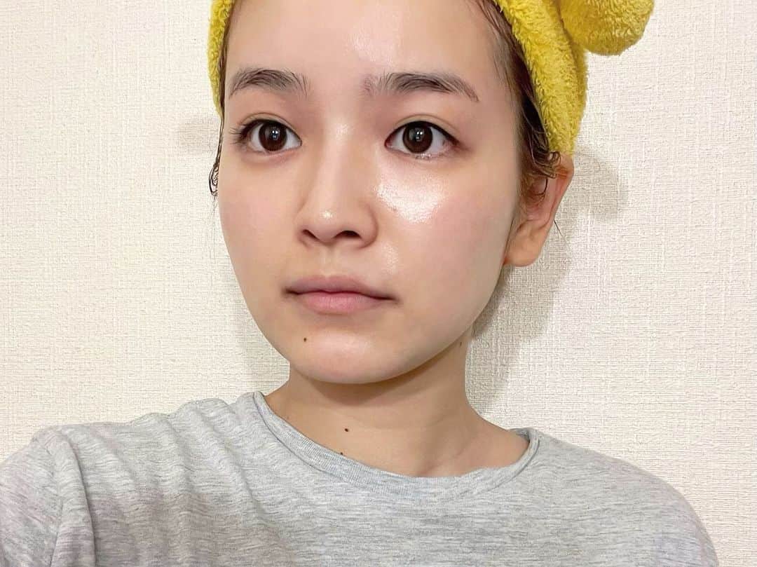 富久美玲さんのインスタグラム写真 - (富久美玲Instagram)「_ . 今回ついに・・・！ . 鼻にあったソバカスとおさらば👃👋 . 1枚目▷施術後1週間経った今日！ 写真では分からない程に薄くなりました🥺  2枚目▷施術前  3枚目▷施術後(赤くかぶれました)  4枚目▷施術後3日が経ったぐらいから 赤みとかぶれも引いたのと同時にポロッと ソバカスが取れて薄くなってました✨ . 施術内容は フォトフェイシャルのルメッカ ➕高濃度ビタミンC点滴 . 担当:工藤ナース . #表参道メディカルクリニック#フォトフェイシャル#ルメッカ#高濃度ビタミンC点滴」9月22日 22時49分 - mirei_official