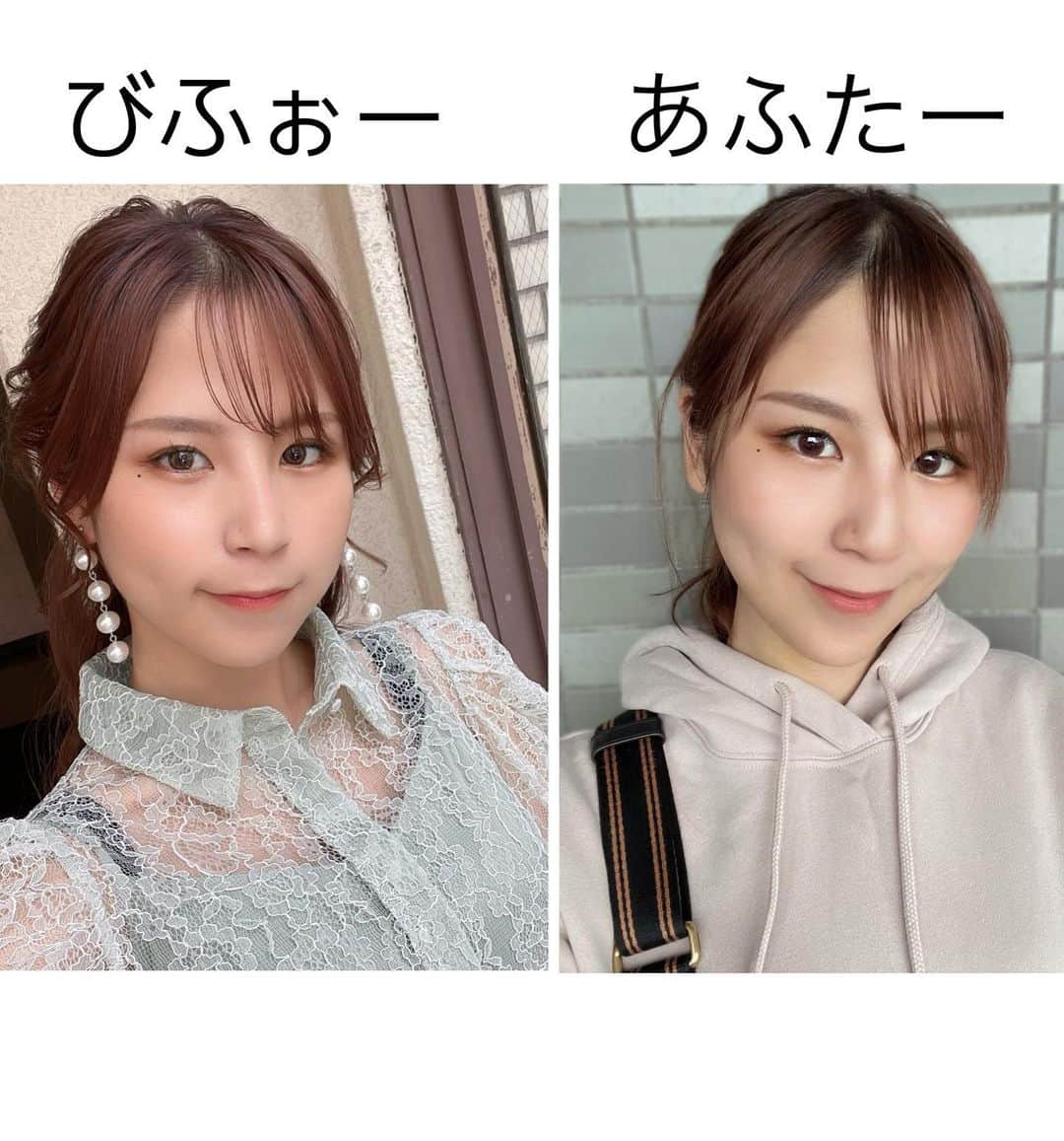 五十川ちほさんのインスタグラム写真 - (五十川ちほInstagram)「𖤐 . . @a_clinic_ginza の惟村先生(@aclinic_koremura)に1day小顔脂肪吸引の施術をしていただいてから、数日経ちました！🧚‍♀️  . 1day小顔脂肪吸引を受けて頬のもたつきがだいぶシュッとした〜🥰 最初の麻酔の針はやっぱりチクチクしたけど、先生が優しく声をかけてくれたので頑張れました\( •̀ω•́ )/🔥 私は体質的に少し腫れやすいのもあるけど、術後の浮腫を差し引いても友達からフェイスラインがあがったねと言ってもらえるのが嬉しい〜🫶♬ これからまだ完成に向かってるので毎日が楽しみ( •̀∀•́ )b . . いまフェイスラインが気になってる方は是非！！ 次はスマイルリップやってみたいなぁ💋♬ . . . #aclinic #aクリニック #エークリニック #aclinic銀座  #惟村公郁 #aclinic横浜 #aclinic新宿 #aclinic名古屋 #aclinic大阪 #美容外科 #美容皮膚科 #1day小顔脂肪吸引 #1day小顔 #aclnic池袋 #aclinic福岡  #脂肪吸引 #小顔 #美肌 #二重あご #フェイスライン #糸リフト #aスレッド #顔痩せ #部分やせ #小顔整形  #小顔になりたい #横顔美人」10月17日 14時03分 - chiho1128_i