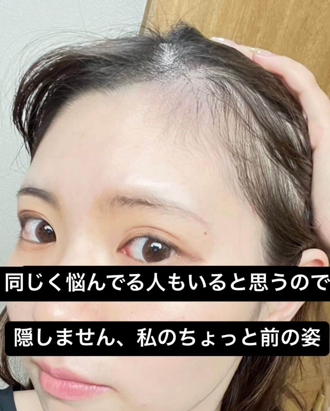 ゆーちゃんさんのインスタグラム写真 - (ゆーちゃんInstagram)「まつ毛 眉毛 生え際つるっパゲから復活したー😭  正しい食生活とオーガニック、無添加 あんまり詳しく書くと投稿消されるので発信控えてますが 本当に食は大事。🫶  マスカラは未使用  マツエクマツパなしの まつげ美容液だけ！  育毛剤は売上ナンバーワンの会社のもの。 ガチで信用してなかったけど普通にリピして何本目かしら(笑) 頭皮ケアできるシャンプーも毎日使ってます。 食生活含め、  全てハイライトに答えてます🙆🏻‍♀️  ハゲってめちゃくちゃ辛いのよね😢 今は短い生え変わりいっぱい！ もう少しかなぁ ーーー   #ハゲ #悩み #まつ毛美容液  #まつ毛  #美容 #脱毛症  #育毛剤  #育毛  #育毛シャンプー  #育毛効果  #無添加 #食生活 #健康 #オーガニック #organic #美容好きな人と繋がりたい」10月17日 18時58分 - yurina_era999