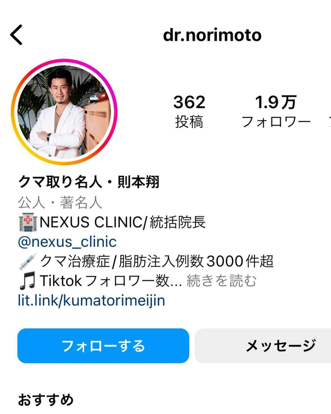 水越愛華さんのインスタグラム写真 - (水越愛華Instagram)「ずーーーっとコンプレックスだった クマとおさらばしました🥺👋❤️  念願のクマ取りをしたので 以下に情報まとめます✍️ (長くなるよ🫣)  ■クリニック 🏥 @nexus_clinic  🥼 @dr.norimoto   ■則本先生を選んだ経緯 ・症例が多い ・SNSでの評判もいい ・カウンセリングの雰囲気が良かった(直感)  ★決め手 "クマ取りしたくてクリニックを探してる" とインスタに載せたところ フォロワーさんがDMをくれて おすすめしてくれて🥹 リアルな感想が聞けたこと、 やってよかったとみんな言っていた事が Nexusの則本先生にする 大きな決め手になりました👨‍⚕️☺️  (ちなみにカウンセリングは 計3カ所に行きました！ クリニックというよりかは、 ドクターで探しました！)  ■施術内容 私のクマは ・黒クマ (目の下に脂肪が溜まっているのが原因) ・青クマ (皮膚の下の毛細血管が透けてしまうのが原因)  の２つのクマに悩んでいたので  ★脱脂＋脂肪注入  になりました🐻  あと、おすすめされたので ついでに額に脂肪注入する ・コンデンスリッチ もしました✌️  ■痛み Nexusでは静脈麻酔で施術するので 痛みは全く無く、 寝て起きたら終わってました☺️  ■ダウンタイム ダウンタイムは クマはあまり腫れなかったけど、 額の脂肪注入が結構腫れました🥲 (写真3枚目)  痛みは特に無かったけど、 3日目と4日目あたりは 結構腫れたので 常に冷やすようにしてました！  (すっぴんで仕事は行ったよ💻)  6日目に初めてメイクはして、 自分ではまだ腫れが気になったけど 周りの人は浮腫んでる程度に 感じたみたい🧐  (メイクは次の日からできるよ)  ■痛み 痛みは本当に特になし🙅‍♀️ 施術も静脈麻酔のおかげで 痛みを感じずに終わるし、 ダウンタイムも 腫れぼったさと熱は感じだけど 痛みは特にありませんでした🙅‍♀️  強いて言うなら 麻酔の針を刺すときと、 脂肪を取った内ももが 数日間筋肉痛みたいな痛みが あったくらいです！ (全然余裕で耐えれた✌️)  ■感想 本当にお世辞なしで、 やってよかった‼️ 後悔してる事は今のところ ひとつも思い当たりません。 毎日、コンシーラーを2種類使って 隠してたくらい気にしてたのに 今ではファンデーションのみで コンシーラーも使ってません😭  周りからも褒められて 余計嬉しくなる、、、  お金はかかるけど、 いいお買い物だったと思います。  クマで悩んでる方、 特に黒クマ(皮膚のふくらみ)は メイクで隠すのは難しいから 本当におすすめです、、、🥹  おでこの脂肪注入も、 当日まで悩んでいたけれど すごくナチュラルで綺麗な丸みがあるおでこになって これまた友達に褒められる😂  BeforeとAfterを比べると 全然違くてびっくりした😂  ダウンタイムは少し気持ちが しんどかったけど、 今となったら本当にやって よかったしかない😭  長年のコンプレックスと おさらばできて心から嬉しいです。 @dr.norimoto 先生 ありがとうございました。🥹  よっ！！クマ取り名人👏🏼❤️笑  #クマ取り」11月26日 22時32分 - iamemika21