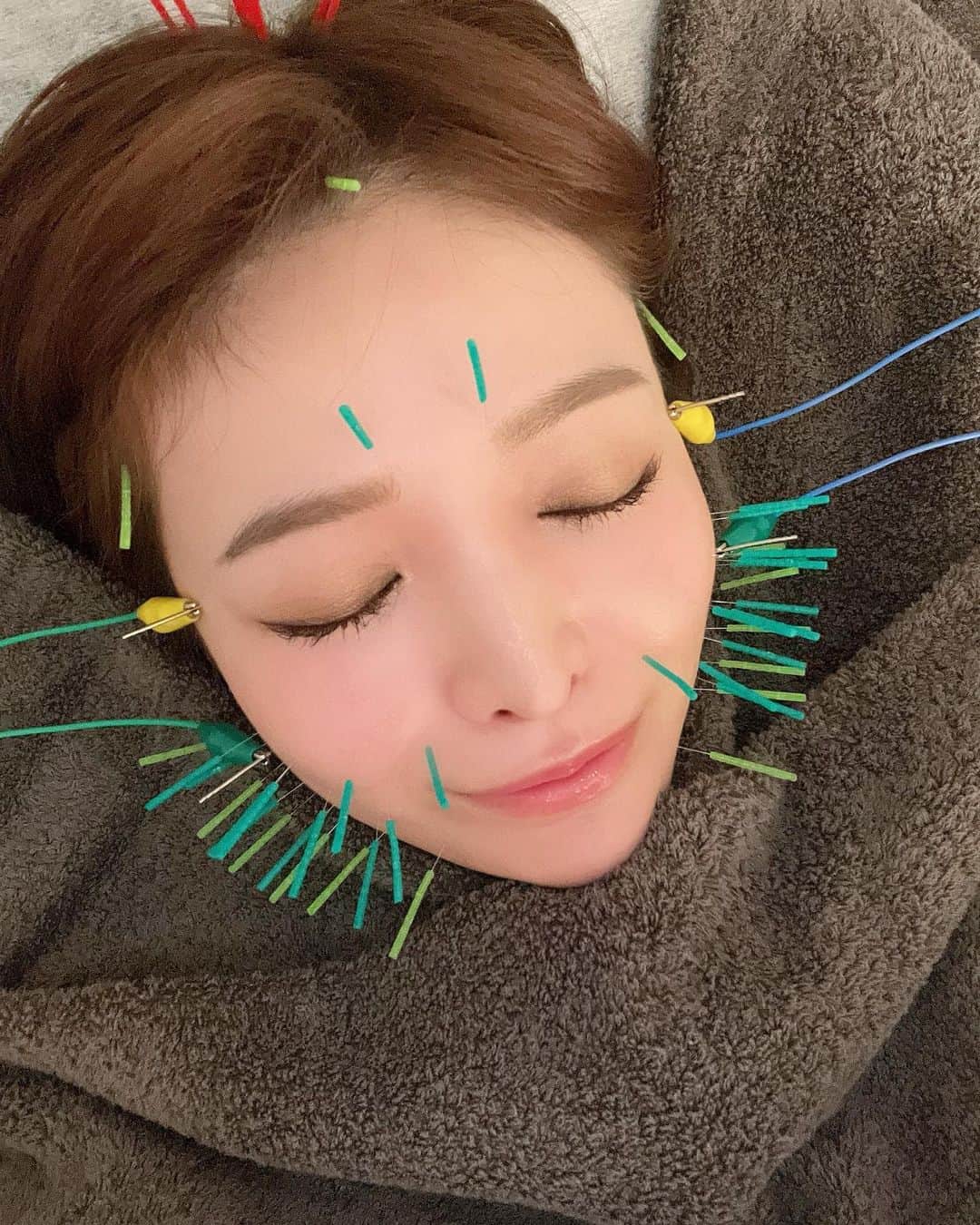 春菜めぐみさんのインスタグラム写真 - (春菜めぐみInstagram)「． 今年の美容初めはVeLine @veline.venus さんで 美容鍼からスタート☺️🤍 ． ． 長年お世話になってる杉崎先生 @sugizakikenya に 美容鍼をしてもらうと、必ず顔小さくなった？って 周りに言ってもらえるの🥺✨ 悩みだった浮腫みがスッキリして 朝起きた時感動する！👏🏻💕 頭にも鍼刺してもらってるけど、全然痛くなくて いつもウトウト寝ちゃうくらいだよ〜😪✌🏻✨ ． ． 今年もたくさんお世話になります🙇‍♀️💓 いつもありがとうございます🥰 小顔効果抜群なので、ぜひ行ってみてね〜✌🏻🌟 ． ． #veline #美容鍼 #杉崎先生 #ハリネズミ #小顔 #beauty #美容 #おすすめ」1月7日 20時58分 - me_haruna.02