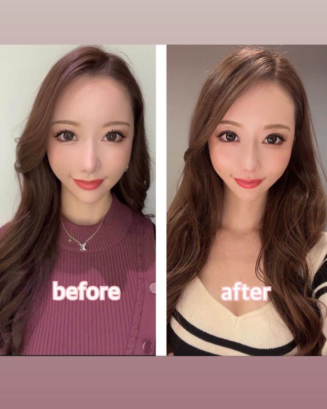 小松崎真理　全裸 小松崎真理さんのインスタグラム写真 - (小松崎真理Instagram)「@aelle_clinic の @dr.wakura  小顔先生こと和倉先生にもっとキュンするリフトの施術していただきました！ とっても明るく、優しい先生で的確にキュッと小顔にしてくれてびっくり🫢‼️  あっという間に終わっ ...