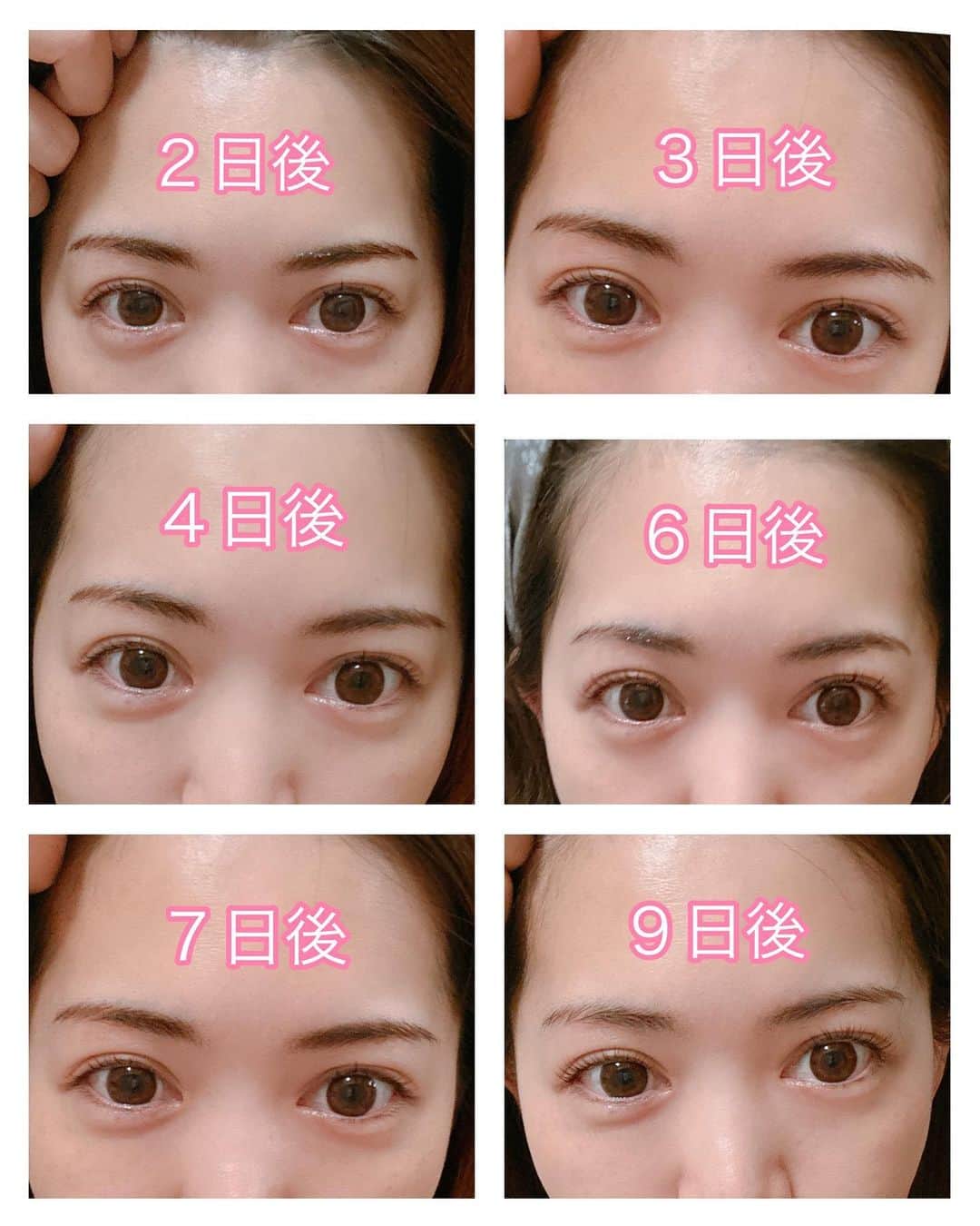 上坂由莉さんのインスタグラム写真 - (上坂由莉Instagram)「⁡ 今でちょうど12日経った感じなんですが、 2回目の眉のアートメイクへ行ってきました💗 ⁡ ⁡ 東京いる頃に一度行ってたんですが、 今回はTHE ARTMAKE TOKYOの大阪院へ 行ってきましたー☺️🪞 @the_artmake_tokyo  ⁡ ⁡ 12月頭に予約させてもらって、 今月中旬に施術してもらいましたよ💓 水野さんのアカウントに載ってるアートメイク、 お写真ずっと見てたから楽しみにしてたんです🪞 何よりお美しさを拝見してたから会うのドキドキ💗笑 @mizuno_artmake  ⁡ ⁡ 当日のカウンセリングは めちゃくちゃ念入りにしてもらって、 左右のバランスなどしっかり見てもらいました☺️ ⁡ ⁡ 眉アートした当日にストーリーのアンケートで アートメイクに興味がある方が８割超えだったので、 経過のお写真を撮ってみました🫶 ⁡ ⁡ ２日目以降の比較写真は、 わかりやすいように条件は全て同じで、 どれお風呂上がりのすっぴん状態の眉毛、 全部同じ場所で撮影してみました🧴🧺 ⁡ ⁡ たまに疲れすぎて撮らずすぐ寝落ちして、 何日か抜けてる所があります😙すみません🙏 ⁡ ⁡ 前回同様、次の日から濃くなって 1週間くらいは濃いままで眉毛のメイクはできません🙅‍♀️ そして、ちょっと痒いですがこれ我慢🥺 かさぶたは無理に外しちゃダメです‼️ ⁡ ⁡ トップの写真は経過10日くらいの時✨ １週間後くらいから綺麗に馴染んできますよ😊 眉のトレンドてどんどん変わるから、 それに合わせれるように自眉ベースで 綺麗に整えて描いてもらいました🫶 ⁡ ⁡ 気になる方見に行ってみてください👸 私は水野さんにお願いしました💗 本当綺麗で優しく施術も丁寧で癒されました🥺 ⁡👸 @mizuno_artmake   📣 私のインスタ見たで¥3,000オフ してくださることになったので、 行かれる方はお伝えしてみてください🥰  ⁡ #theartmaketokyo #アートメイク #眉アートメイク #眉アート #眉メイク #美容好き #アートメイク大阪 #眉毛サロン #アイブロウ #大阪美容クリニック #ビフォーアフター #眉毛の整え方 #梅田カフェ #いちごショート #大阪カフェ #梅田」1月25日 21時38分 - yuri_yoga.727