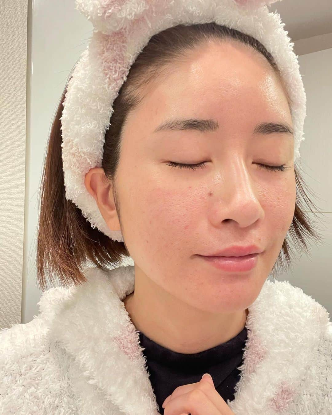 KAORI.OMURA 大村香織さんのインスタグラム写真 - (KAORI.OMURA 大村香織Instagram)「ハリってこの事だ‼️ 施術後2日目に ハッと気が付いた！ ※施術動画が10枚目にあるので 血が🩸苦手な方は注意  施術後翌日 ランチ時に顔を触ったら 手のひらの中の感触が 少し違うかったので 私、顔浮腫んでるか 確認したら浮腫んで無かったの  でも何か違う、いつもと  そう ストーリーズにアップしていた 陶器肌メソガンで ヒト由来臍帯幹細胞培養上清液を 全顔に打ってました！  幹細胞の威力を身を持って 感じた  艶も翌日朝に鏡を見たら艶っとしてた 針の跡があるけども艶はある ※3枚目  赤くポツポツとあった 針の後は4日後辺りまで うっすらはあったかな？  お化粧は翌日から出来るし ２日目からは針跡も 解らない程に✨  満足度高い施術🙆‍♀️  気になる痛さは 針の深さによると思うけで 今回1ミリ  ダーマペンより少し痛かったけど 深さがダーマペンはもう少し浅かった  我慢できるよ！ （塗る麻酔してくれる）  クリニックは 渋谷の駅近、宮益坂にある  📍渋谷国際クリニック　@shibuya_kokusai   新しくできたクリニックで 綺麗なクリニックでした✨  #美容医療 #艶肌#ハリ#アラフォー#アラフォー美容#綺麗になる #40代美容 #渋谷国際クリニック #メソガン #ヒト由来臍帯幹細胞培養上清液#陶器肌#陶器肌メソガン#公園で#美肌」1月30日 17時38分 - kaori.omura