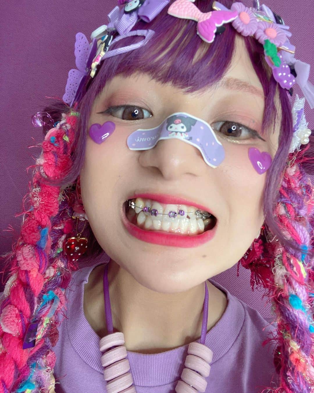しなこさんのインスタグラム写真 - (しなこInstagram)「前歯に矯正つけてまだ1年も経ってないんだけどさ！！！ 八重歯も無くなったし ...