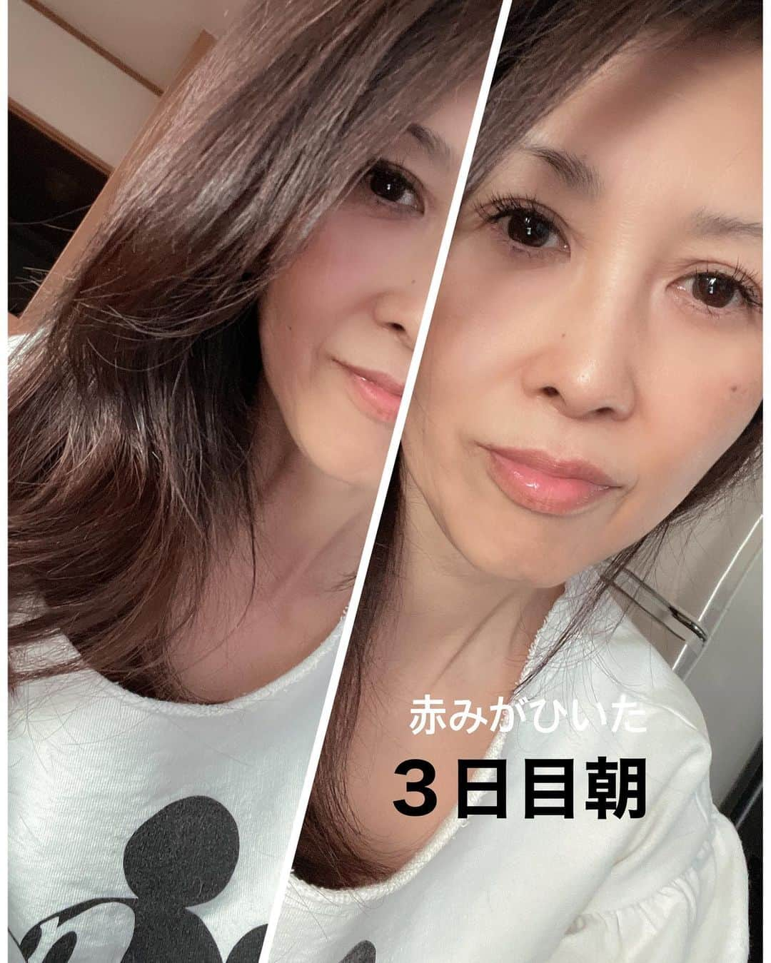 Naoko（なおこ）さんのインスタグラム写真 - (Naoko（なおこ）Instagram)「☺︎ ☺︎  BQCELL(ビーキューセル) ダーマスキンピーリング ハーブピーリング セルフ ケア  を やってみました  （投稿順番が 時系列ではなくて ごめんなさい🙇‍♀️）  エステでやるやつ うちでやる感じ  ちょっと緊張しましたが やってみたら すごく簡単 ただ チカチカピリピリは します。  注射器に入ってる 薬材を塗布し、 そのまま寝るだけ。 （７時間以上放置）  ダウンタイムが必要だから おやすみ前がおすすめ。 素顔で２日間過ごします。 皮膚が無防備な状態で 日焼け注意なので わたしは２日間カーテンしたまま、部屋からでてませんでした。  1️⃣３日目までは 油分のあるスキンケア禁止  2️⃣メイクも油分があるから なるべく禁止  ４日めからは皮膚が剥離してくるから 保湿をいつも以上に気をつけてあとは 通常どおり。  若い人は ターンオーバーが はやいので、 より効果あるみたい。  ゆでたまご肌に なるといいね。  土日は、 うちに引きこもり 地球の誕生や、 登山家のドキュメンタリーや（またか！） みまくって、文明社会との ギャップに萌えた なおこなのでした。  ダーマピーリングで 肌の生まれ変わりと 同時に ネイチャーなおこが 誕生したようです。  おぎゃー！ すぐに 影響されてはまる性格 まだ健在、、笑  #BQCELL #ダーマスキンピーリング #毛穴ケア #ハーブピーリング #カンナムドール （#PR） #筋トレ女子 #フィットネス女子#フィットネス#Fitness#筋トレ女子と繋がりたい #筋トレ好き#筋トレ好きと繋がりたい#減量 #くびれ#美ボディ #アラフィフ#アラフィフコーデ#ボディメイク #50代#健康 #熊本 #kumamoto」3月5日 16時58分 - smile_naohibi