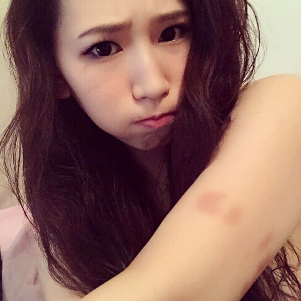 佐山愛のインスタグラム：「昨日エステ行ったとき、二の腕は痣が痛むから軽くさする程度にしてもらったんだけど、血行良くなったからか痣が濃くなったww  噛み跡早く消えてー(´・ω・`) #二の腕噛まれた #しかも2箇所 #歯型くっきり #ラブの二の腕噛んだの誰だよw」