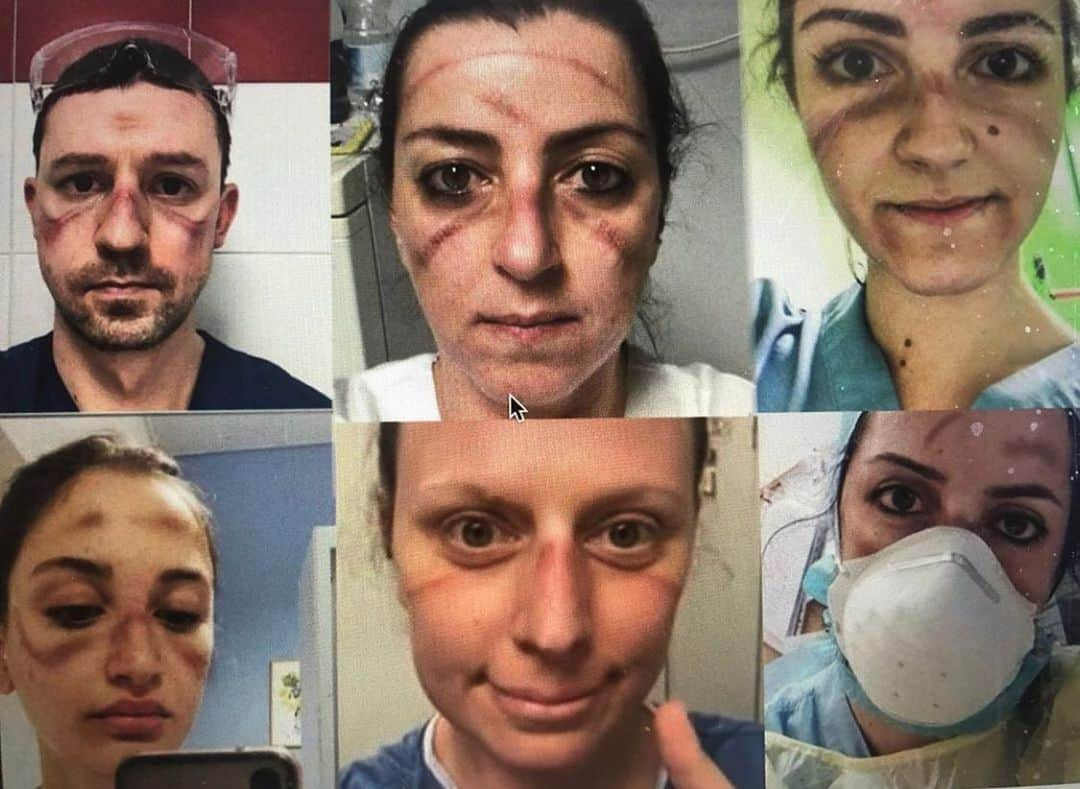 マーサ・ハントさんのインスタグラム写真 - (マーサ・ハントInstagram)「#IStayHomeFor the medical experts & healthcare workers on the front lines around the world.🙏These selfies are of doctors and nurses in #Italy - the marks on their faces indicate how long they have been wearing masks/ eye shields working around the clock❤️#heroes #stayhome」3月23日 5時26分 - marthahunt