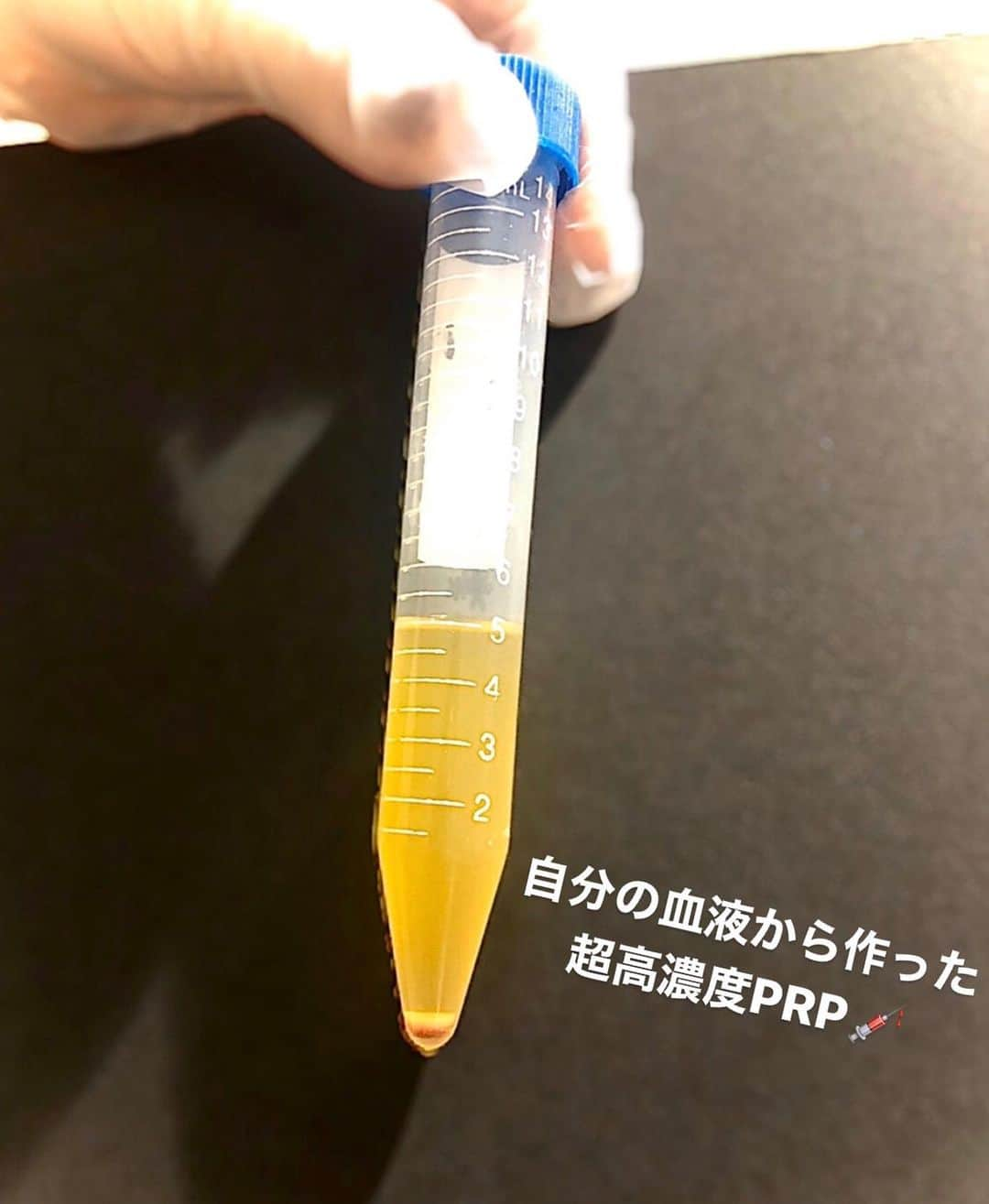 央川かこさんのインスタグラム写真 - (央川かこInstagram)「ぷるぷる注射してきたよ💉✨ ・ 自分の血液を取って、 それを約30倍の超高濃度にしたPRPを おでこと目の下に入れてもらいました🙏 ・ 肌再生の治療だから細胞が活性化されて お肌がぷるぷるつやつやになったし、 効果は3〜4年くらい続くんだって🙌💓 ・ 注射してから3日くらいは少し腫れたけど、 今は顔全体が自然な感じでハリが出てる😍✨ ・ #ぷるぷる注射 #プルージュ美容クリニック #PRP #美容医療 #美容 #レースクイーン #ラウンドガール #モデル #ダイエット #トレーニング #筋トレ #ファスティング #オフショル #ニット #ファッション」3月24日 17時59分 - kako.717