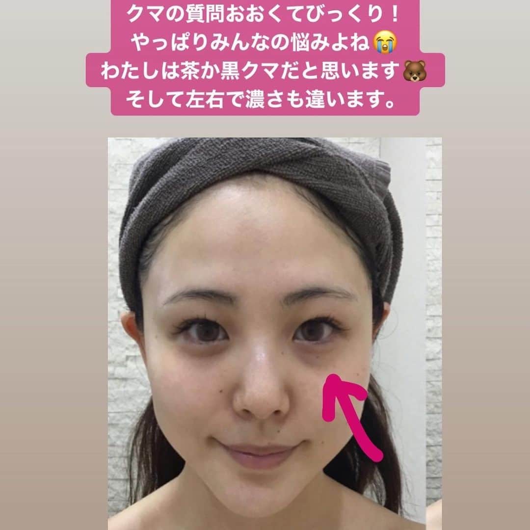 りーまるさんのインスタグラム写真 - (りーまるInstagram)「本気通いしてる美容サロンは、、 スワイプしてね▶︎▶︎▶︎ ・ ・ ハイライトに残してます🙆‍♀️ （4つ目の画像参考にしてください） ・ ・ ちなみに現在クマ治療をしてて、 昨日は2回目を いつもお馴染み @ebisu_beauty_clinic  @horie_yoshiaki に してもらってきました🙆‍♀️ ・ ・ こちらは炭酸ガスで血流を良くし、 ちょっとずつクマを改善していくものになります🙆‍♀️💓 ・ ・ 昨日ストーリーに載せたら クマでお悩みの方多くて、 だよね！だよね！と思いました🥺💓 ・ ・ こちらは整形ではないので 一度でがっつり変化はおきないのですが、 小さな頃からの大敵黒クマちゃんが薄くなるのが目標です✊ ・ ・ ・ ・ ちなみに 髪のケアもここ最近は本当に重要視してて、 こちらもいつもお馴染み @jas_kami に @tokio_inkarami  のハイパーTOKIOの方を 定期的にしてもらってます🙆‍♀️ ・ ・ これをするようになってから 美容師さんに髪褒められるようになって、 そのたびにうふふ🙊💓 と思ってます！ ・ ・ トリートメントのおすすめは？ の質問もよく頂くんですが、 ダメージ多めな髪なわたしには オージュアとTOKIOが1番すきかもです🐶💭 ・ ・ 同じくハイライトにまとめてるので 参考になりますように💐 ・ ・ ということで、 今回はがっつりガチおすすめ特集でした🤗✨ ・ ・ ・ 10年前は化粧品やお洋服、ネイルなど 着飾る方にお金を使ってたけど、 今はメンテナンスが大事だなぁと 思う年齢になりました😂💓 楽しく歳を重ねたいです🐶✨ ・ ・ ・ #恵比寿美容クリニック  #クマ治療 #りーまる美容  #TOKIOトリートメント #銀座サロン ・ ・ ・ #りーまる #サロンモデル #インフルエンサー #フリーモデル#撮影データ #撮影モデル募集 #広告モデル #ポートレートモデル #被写体#カメラマンさんと繋がりたい#美容クリニック #美容外科 #美容皮膚科 #美容整形 #美容整形外科 #女子力アップ#美容好きな人と繋がりたい #美容垢#美容オタク#美髪ケア #美容クリニック#透明感#オージュア#透明感#アラサー女子 #プチプラコーデ  #韓国好きな人と繋がりたい」3月25日 8時27分 - riii_maru162cm