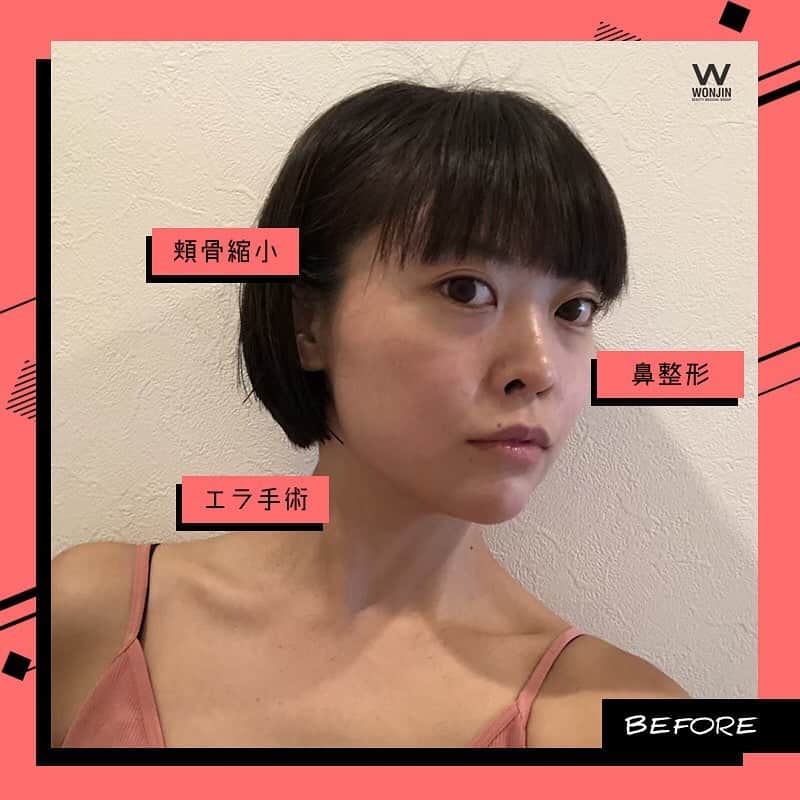 ウォンジン美容整形外科、皮膚科さんのインスタグラム写真 - (ウォンジン美容整形外科、皮膚科Instagram)「⠀ ウォンジン整形外科 ⠀ 日本人モデルたちの リアルビフォーアフター💞 ⠀ あやかさん&ゆいさん&みおり舞さん 3人の日本人モデルがウォンジンで手術‼️ 美しく変身した皆さんのビフォーアフターをチェック😍 ⠀ 写真を送っておすすめ手術&見積もりが簡単にわかる😊 オンラインカウンセリングも可能📲 ⠀ お問い合わせはウォンジン公式ライン(@wonjin)までご連絡下さいませ📩 ⠀ (美容整形、芸能人の皮膚管理ノウハウ、アイドルのダイエット秘訣など 日本カウンセリング会予約・各種イベントについてもこちらへ💁♀✨) LINE: @wonjin SITE:jp.parkwonjin.co.kr E-mail: wonjin.jpn@gmail.com ⠀ #韓国美容整形 #韓国美容外科 #韓国整形 #整形 #美容外科 #ウォンジン #ウォンジン整形外科 #美容整形 #輪郭手術 #鼻整形 #リフト #小顔整形 #ビフォーアフター #症例写真 #日本人モデル #モニターモデル #モデル募集 #割引実施」3月25日 9時52分 - jp.wonjin