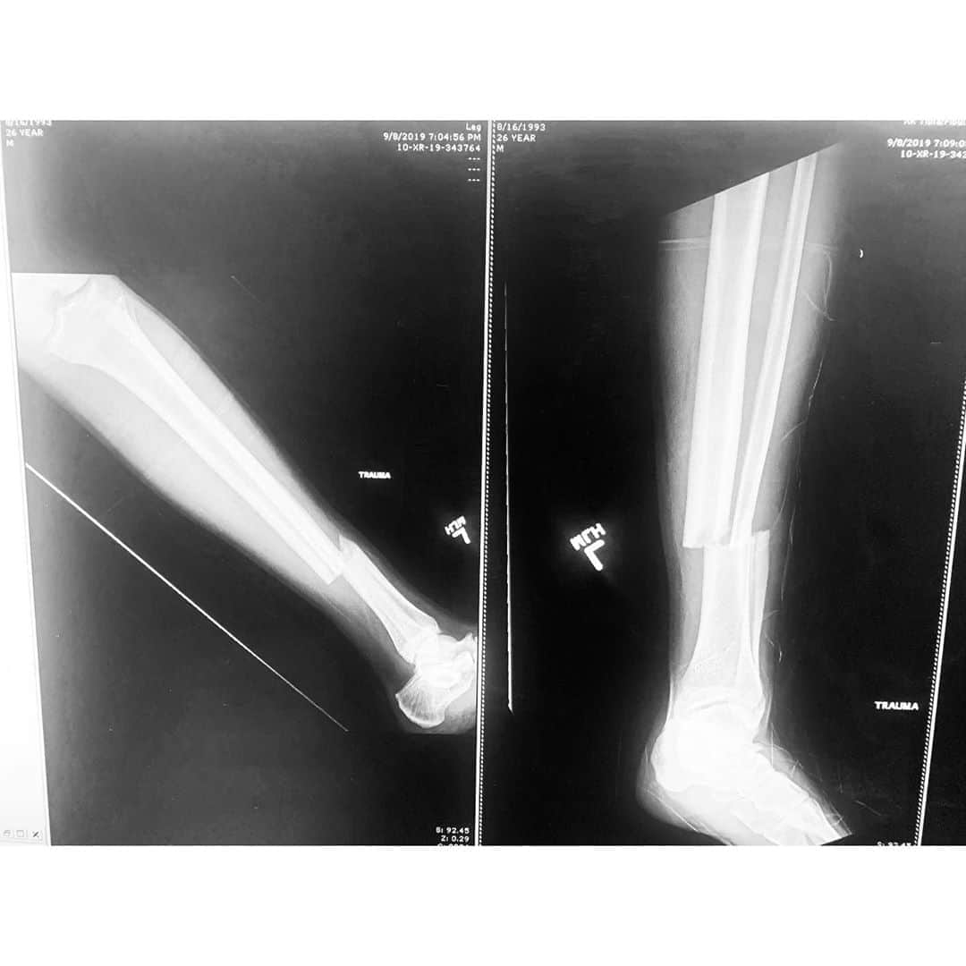 キャメロン・モナガンのインスタグラム：「I wrote a blog post on breaking my leg last year. You can read it at cameronmonaghan.net or by visiting the link in my bio.」