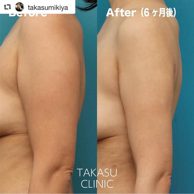 高須クリニック名古屋院さんのインスタグラム写真 - (高須クリニック名古屋院Instagram)「#repost @takasumikiya via @PhotoAroundApp  太い二の腕を脂肪吸引で細くした症例 ・ 40代女性の患者様で、太い二の腕を細くしたいというご要望でした。 診察させていただいたところ、全体的にややぽっちゃり体型で、全身に皮下脂肪が多めについているタイプでした。 特に、二の腕から肩、ワキにかけてたくさん皮下脂肪がついており、腕が太く、肩幅が広く見えていました。 患者様は最初から脂肪吸引を希望されており、十分に皮下脂肪がついていて脂肪吸引の適応があったため、脂肪吸引をすることになりました。 ・ 手術は全身麻酔下に行い、肩〜二の腕〜ワキにかけて広範囲に皮下脂肪を吸引しました。 ・ 手術後は肩〜二の腕〜ワキが一回り細くなり、すっきりした印象になりました。 また、肩の皮下脂肪が減って腕も細くなったため、肩幅が狭く見えるようにもなりました。 ・ 【料金】 ●脂肪吸引 両ウエスト：200,000〜300,000円 下腹部：380,000〜570,000円 上腹部：200,000〜300,000円 両上腕部：280,000〜420,000円 両大腿（内側・外側・前面・後面・膝回り）：各380,000〜570,000円 ふくらはぎ：380,000〜570,000円 おしり：380,000〜570,000円 頬・顎：各280,000〜420,000円 背中：380,000〜570,000円 ※すべて税別価格 ※料金は2020年3月17日現在 ※保険適用外、自由診療 ・ 【リスク・副作用など】 ●皮膚のたるみ・不自然な凸凹や段差（脂肪を吸引し過ぎた場合） ●内出血（術後） ●仕上がりのわずかな左右差（完璧なシンメトリーは不可） ●カニューレ挿入口の傷跡が肥厚性瘢痕やケロイドになる可能性 ・ 【ご予約・お問い合わせ】 名古屋院☎︎ 052-564-1187 名古屋院📱 @takasuclinic_nagoya ↑名古屋院インスタのプロフィール画面からも直接コンタクトが取れます📲 https://www.takasu.co.jp/ ・ ・ #高須クリニック #高須クリニック名古屋院 #高須幹弥 #高須英津子 #美容整形 #整形 #二重 #埋没法 #二重切開 #ヒアルロン酸 #鼻 #ニキビ #豊胸 #たるみ #しみ #シワ #ほうれい線 #整形したい #美容好きな人と繋がりたい #可愛くなりたい #綺麗になりたい #平行二重 #末広二重 #プチ整形 #二重整形 #痩せたい #たるみ改善 #ビフォーアフター」3月31日 14時32分 - takasuclinic_nagoya