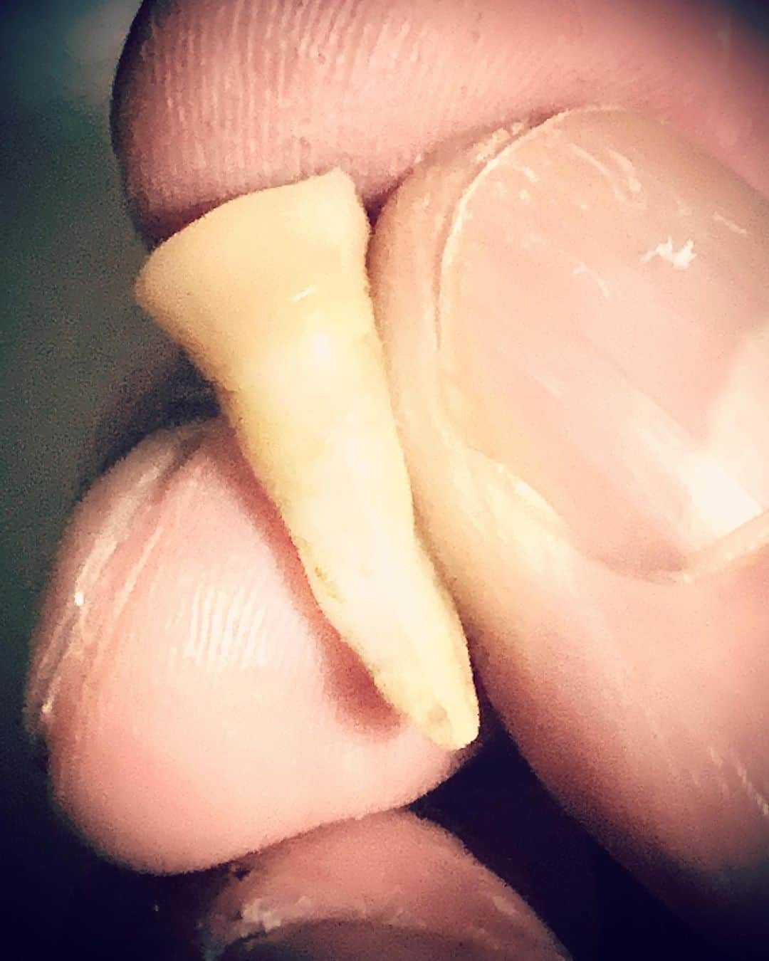 樫原伸彦さんのインスタグラム写真 - (樫原伸彦Instagram)「. 朝からいろいろやって、 気が抜けたら 歯も抜けた。  20年くらいグラグラしてたやつが ポロっと綺麗にw ご苦労様でした。  歯医者にダイブ。  抜けた歯はどうにもならないらしくw ずっと痛かった反対側の虫歯を先に治療してもらうことになり久々の工事。 麻酔が切れてズキズキ痛むなう😭  明日またいってみてもらう。  とゆぅ、  なんでもない話（歯無し）  #歯 #teeth #dental #dentist」4月1日 1時00分 - nobustagrammy