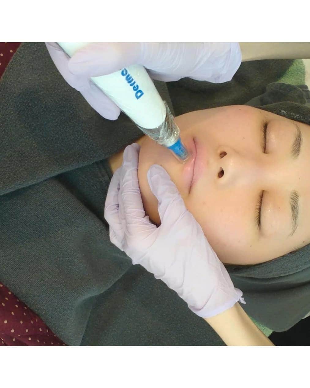 松浦麻里奈さんのインスタグラム写真 - (松浦麻里奈Instagram)「新宿のコマ劇場の近くにある、エレナクリニックで (@elena__clinic ) シャインニードル（ダーマペン4）  受けに行って来ました😊❣❣❣ .  毛穴・美白・美肌・引き締め ・ハリ感のアップするために👍✨ . . . ▼ダーマペンとは、極細の針を刺していきます。 針を皮膚の真皮層まで通すことで、 傷を治そうとする自然治癒力によって、 お肌を本来の状態に戻していきます。 お肌に垂直に針を通すため、 皮膚への負担が少なく、翌日からのメイクも可能😳✨ . お顔ダーマペンしながら入れる 薬剤はヒアルロン酸(๑¯﹀¯๑)  表面麻酔するから、全然痛くなかった～(*˙˘˙)♡ 唇から、眉デコ上まで全顔施術🙌💕🎶 .  音は怖いけど、施術中は細かに声をかけてくれたので 安心して受けれたよ(*´ ˘ `*)♡ . 施術直後は、多少赤みがあるけど 翌日から段々と引いてきた🙆✨ . . 痛みもないし、あとは肌が綺麗に なっていくのを待つだけ😆💓 . . うる艶になれーっ.•*¨*•.¸¸♬ . . . #エレナクリニック #ヒアルロン酸  #ダーマペン4 #水光肌 #美肌  #ツヤ肌 #美容クリニック #美容皮膚科 #新宿 #pr #美容 #beauty #肌ケア #施術動画 #シャインニードル #ダウンタイム #皮膚科 #東京 #美容好き #スッピン #素っぴん  #make #素肌美人 #引き締め #facecare #フェイスケア #ビューティ」4月3日 8時19分 - ay114.831m
