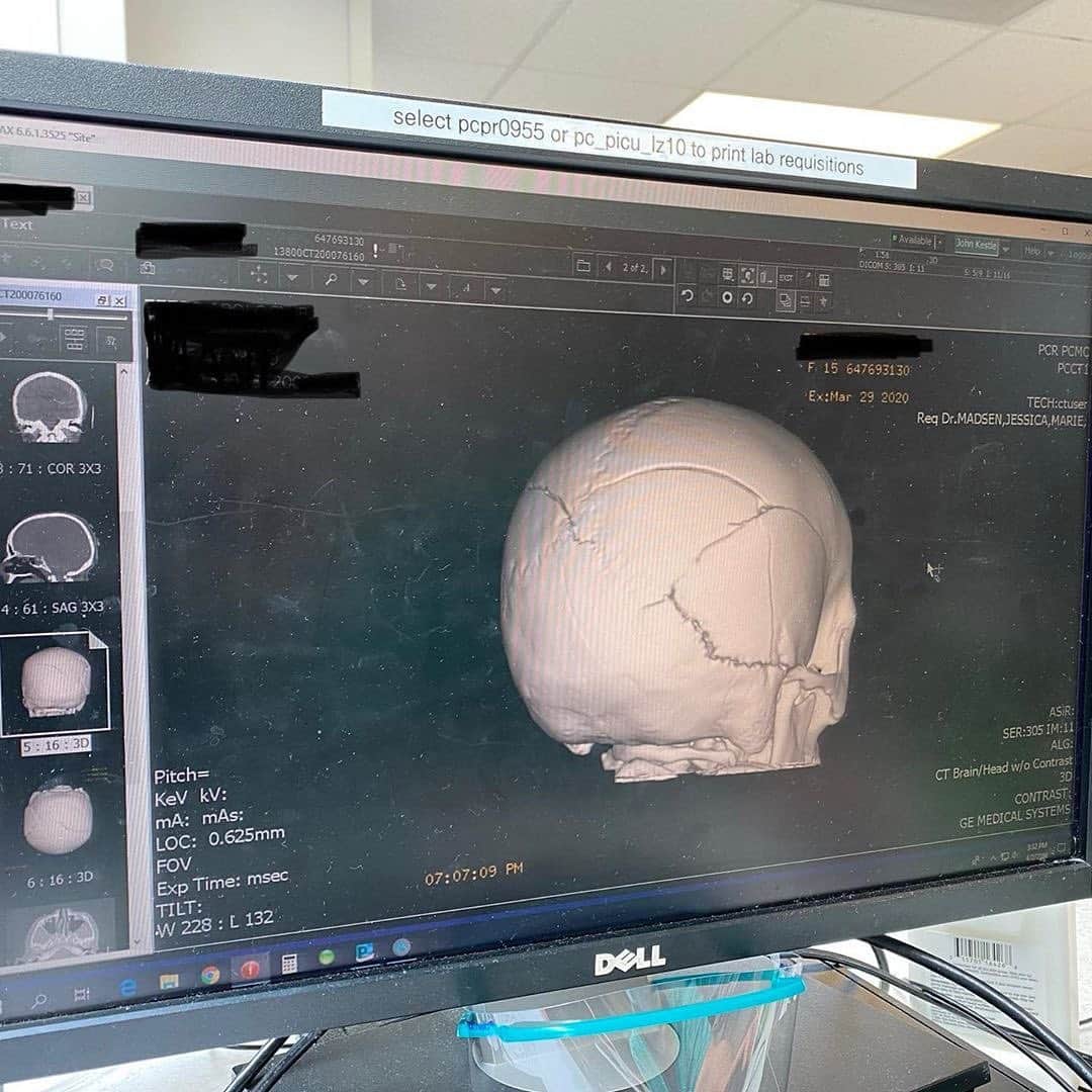 ミッチェル・マネーさんのインスタグラム写真 - (ミッチェル・マネーInstagram)「Repost from Brielles dad  @rcmoney • Update: April 3rd @ Noon *The CT scan yesterday (the pics of her skull and the fractures are from this CT Scan) gave us a bunch of good news. The bruising and swelling in Brie's head has gone down. No new swelling. *Also, Brie had a blood clot in her jugular, the angiogram showed the blood is now flowing through that vein. *The nurses worked overtime and got Brie on an airbed. This will allow them to move her around better and be more comfortable for her. Keep in mind at Primary Childrens there are a lot of small kids who are a lot easier to move around. Brie being older has its pluses (more tolerance of medicine) and its disadvantages (she is hard to move around and it takes longer to do most anything with her). *Michelle went in last night @ 8pm. Brielle had the worst night since she has been there. The pressure in her brain was almost twice as high as it has ever been. It was a rough night and definitely for the 2 steps forward she had with the Scans yesterday this was a step back. The doctors are not sure why this happened and have been working on her all morning. She had a lot of fluid in her lungs and they sucked that out, along with congestion in her sinuses. Brie is definitely at risk of infection. They have her on antibiotics but this also has its negative side effects. They have since got her pressure down a bit but are giving her much larger doses of medicine. They said that if her numbers get up that high again they will have to put her in a deeper comatose state/ medically induced coma. They have been trying to wean her off of these drugs and it does not seem like that is going to happen today. - we have had a bit of negative news today. Been a tough one. - THANK YOU again for your prayers - we are using them up. I will update again probably later tonight.」4月4日 4時57分 - michellemoney