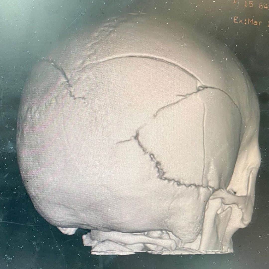 ミッチェル・マネーのインスタグラム：「Repost from Brielles dad  @rcmoney • Update: April 3rd @ Noon *The CT scan yesterday (the pics of her skull and the fractures are from this CT Scan) gave us a bunch of good news. The bruising and swelling in Brie's head has gone down. No new swelling. *Also, Brie had a blood clot in her jugular, the angiogram showed the blood is now flowing through that vein. *The nurses worked overtime and got Brie on an airbed. This will allow them to move her around better and be more comfortable for her. Keep in mind at Primary Childrens there are a lot of small kids who are a lot easier to move around. Brie being older has its pluses (more tolerance of medicine) and its disadvantages (she is hard to move around and it takes longer to do most anything with her). *Michelle went in last night @ 8pm. Brielle had the worst night since she has been there. The pressure in her brain was almost twice as high as it has ever been. It was a rough night and definitely for the 2 steps forward she had with the Scans yesterday this was a step back. The doctors are not sure why this happened and have been working on her all morning. She had a lot of fluid in her lungs and they sucked that out, along with congestion in her sinuses. Brie is definitely at risk of infection. They have her on antibiotics but this also has its negative side effects. They have since got her pressure down a bit but are giving her much larger doses of medicine. They said that if her numbers get up that high again they will have to put her in a deeper comatose state/ medically induced coma. They have been trying to wean her off of these drugs and it does not seem like that is going to happen today. - we have had a bit of negative news today. Been a tough one. - THANK YOU again for your prayers - we are using them up. I will update again probably later tonight.」