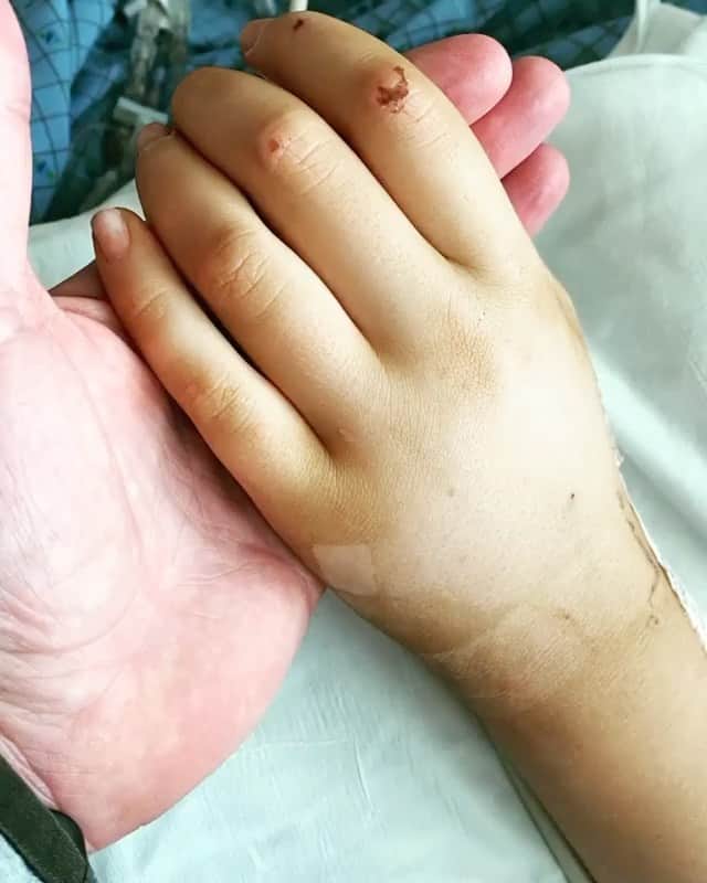 のインスタグラム：「Repost from @rcmoney • Update: April 9th 11am SO MUCH PROGRESS!!! I do not say this flippantly, your prayers are being heard and felt. Brielle is doing so well. She is off almost all of her IV medications. She is still on the Dilaudid but they are trying to get her off of that today. They will switch to giving her morphine through a feeding tube. The nurse said that it is a 20 day weaning process on morphine to get her off of the pain, sedation and paralytic medicines. Brielle started moving and will raise her eyebrows when 'yelled' at or pinched. The medical staff is asking her to squeeze their fingers or move her toes and she will do it most of the time. Her left side is definitely more responsive than her right side. She moves her left hand a lot (video) and is getting some expressions in her face. - The sensor is out of her head!!!! So happy about that. TODAY - Brielle is getting an MRI and CT scan around noon. She might not need the CT scan, they are checking with Trauma to see. Here is some other big news, depending upon how early we get this MRI done and how much sedation/paralytic they have to give her to hold still, she could potentially get extubated today (where they take that breathing tube out of her throat). That would be such a big thing for Brielle, I know she hates that breathing tube. So please keep her in your thoughts that her MRI and CT scan will go well and that they will be able to take that breathing tube out. If the MRI comes back good then they will be able to take the neck brace off too!!!!!! LET'S GO!!! Brielle, we are so proud of you! For her to start moving made us all cry...」