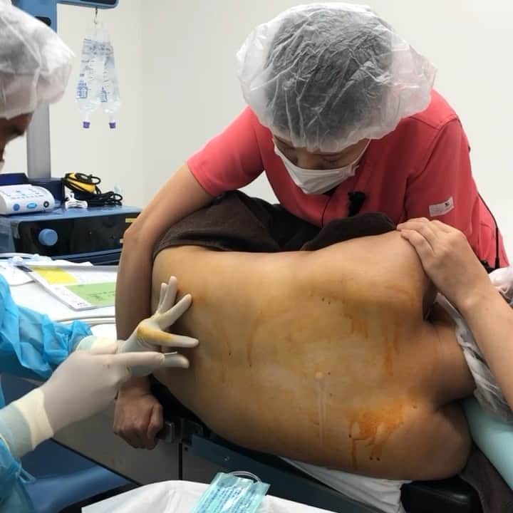 のインスタグラム：「埼玉からご来院！他院の再手術！おなかの脂肪吸引！術中劇的変化【#epidural for liposuction! 】For watch the full video :YouTube:sbctakeda 脂肪吸引に対する#硬膜外麻酔　の模様です。動画のフルバージョンはYouTubeでsbctakeda-epidural と検索してください！硬膜外麻酔の動画だけではなく美容医療に関する動画を７０００例ほど掲載しています！私は美容外科医であると同時に現役の麻酔科医でもあります。美容外科医としての休日は一般病院の手術室で麻酔技術の向上と知識のアップデートに励み、私のところにご来院される患者様に対しより一層安全で安心していただける麻酔を提供し続けています。 ٩(๑❛ᴗ❛๑)۶ ぜひ竹田先生の オフィシャルホームページも ご覧ください！！ 竹田啓介 オフィシャル  と検索するか、以下のアドレスへ！  http://shiboukyuuin-takeda.com/#  #湘南美容外科 #湘南美容クリニック新橋銀座口院 #脂肪吸引 #豊胸 #根こそぎ #竹田 #竹田先生 #相川佳之 #美容外科 #美容整形 #横浜 #ダイエット #sbc #SBC #liposuction #followme #脱毛 #新橋 #新橋銀座口 #銀座 #コリドー街 (๑･̑◡･̑๑)」