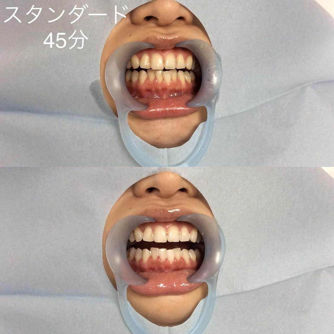 ホワイトニング専門クリニック ホワイトラボ東京 渋谷さんのインスタグラム写真 - (ホワイトニング専門クリニック ホワイトラボ東京 渋谷Instagram)「* 9月〜11月は #結婚式 シーズンです💜 #前撮り #挙式 #ブライズメイド の皆様も！ 2週間前位に #ホワイトニング に来ていただければ ばっちり間に合います👌 1回で十分な方も多いですが 歯の質やコースによっては2回〜3回来ていただくこともございます。 #ブライダルホワイトニング は是非お時間に余裕を持って 受けに来てください👰🤵💍 * * 銀座院限定ですが、ホワイトニングをしながら #ブライダルネイル も可能です。 プロが出張してきてくれます✨ 2週間以上前の予約が必要になりますのでご注意下さい。 ※こちらは電話で必ずお問い合わせ下さい💅 * * #プレ花嫁さんと繋がりたい #卒花 #結婚準備 #life #最高の日 #きれいになりたい #ファッション #トレンド #オフィスホワイトニング #歯のホワイトニング #審美歯科 #矯正 #インビザライン #歯を綺麗にする #美容 #短時間の施術 #会員数100000人もうすぐ突破 #女医が担当します #歯科衛生士 #ホワイトニングコーディネーター」8月10日 15時47分 - whitelabtokyo