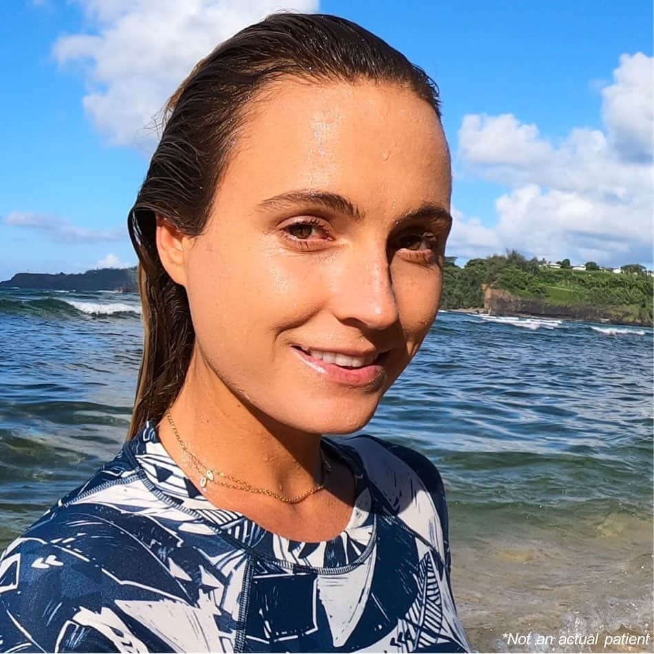 アラナ・ブランチャードのインスタグラム：「#ad For full Product Information for BOTOX® Cosmetic (onabotulinumtoxinA) including Boxed Warning and Medication Guide, see @botoxcosmeticpi  Hawaii is my favorite place in the world, and I’d love to share it with you. I’ve teamed up with @BOTOXCOSMETIC to give you a chance to win an amazing trip to Hawaii that includes surf lessons and more! 🏄 Check out the link in my bio for info on how to enter the #sweepstakes. ☀️ NO PURCHASE NECESSARY. Eligibility restrictions apply, see full OFFICIAL RULES for details. Void in AK, FL, outside the 50 U.S./D.C. and where prohibited. Ends 8/30/19. For full Official Rules, visithttp://bit.ly/2ILMaiA.  BOTOX® Cosmetic is FDA approved to temporarily make moderate to severe frown lines, crow’s feet, and forehead lines look better in adults.  Talk to your doctor about BOTOX® Cosmetic and whether it’s right for you. There are risks with this product - The effects of BOTOX® Cosmetic may spread hours to weeks after injection causing serious symptoms. Alert your doctor right away as difficulty swallowing, speaking, breathing, eye problems or muscle weakness can be a sign of a life-threatening condition. Patients with these conditions before injection are at the highest risk. Side effects may include allergic reactions, neck and injection-site pain, fatigue and headache. Allergic reactions can include rash, welts, asthma symptoms, and dizziness. Don’t receive BOTOX® Cosmetic if there’s a skin infection. Tell your doctor your medical history, muscle or nerve conditions (including ALS/Lou Gehrig's disease, myasthenia gravis, or Lambert-Eaton syndrome), and medications, including botulinum toxins, as these may increase the risk of serious side effects.  BOTOX® Cosmetic is available by prescription only.」